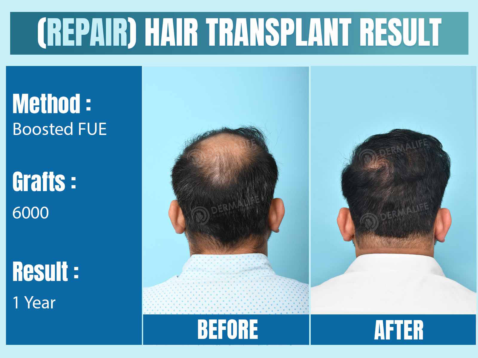 Before and After Results of Hair Transplant for Crown