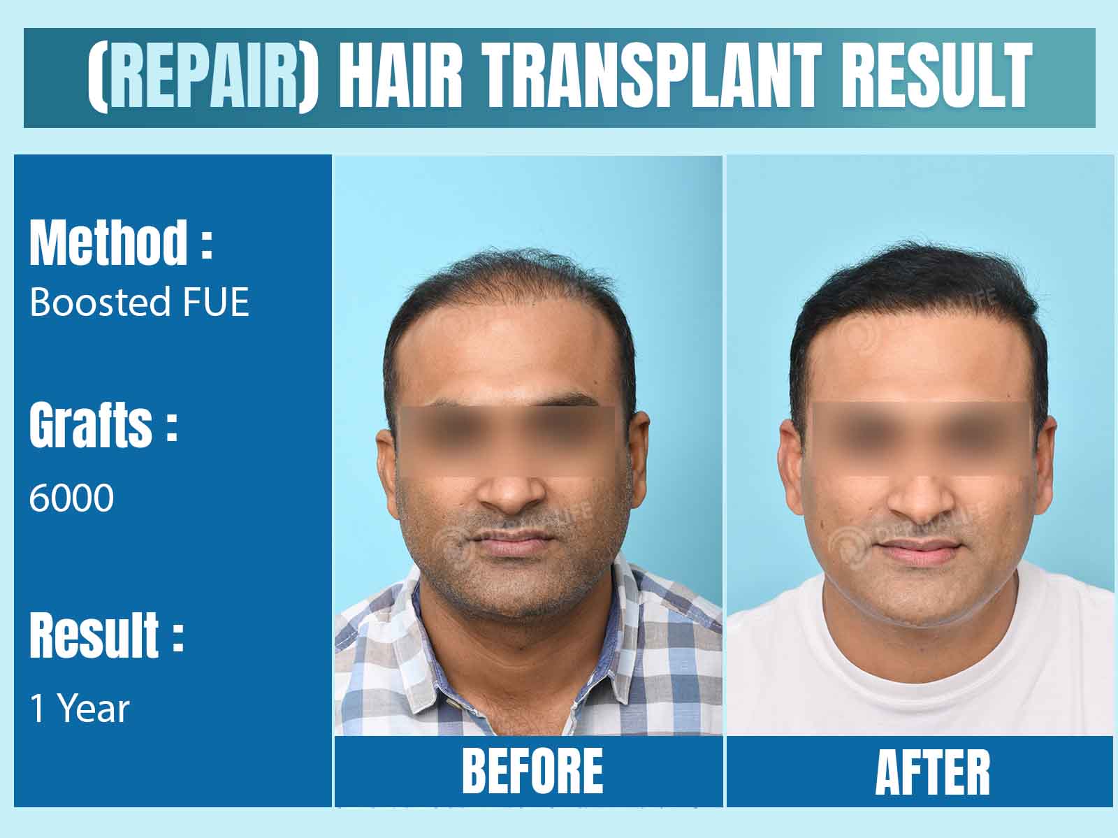 Before and After Results of Hair Transplant for Repair/ Corrective Hair Transplant