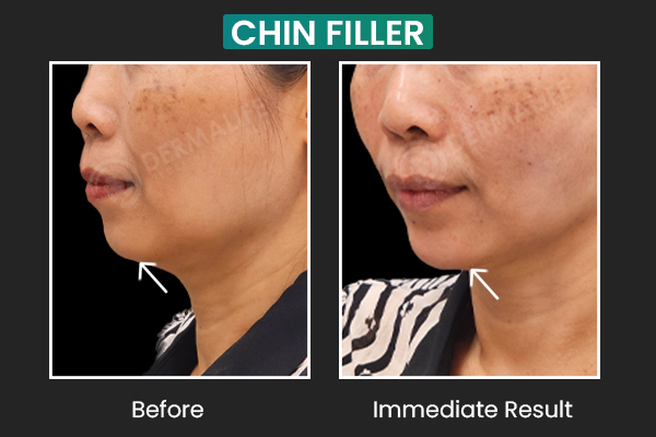 Best Chin Fillers Cost in Delhi