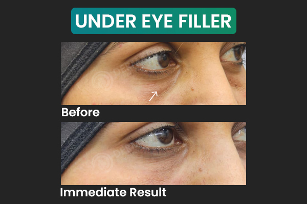 Best Fillers under eye Clinic Delhi