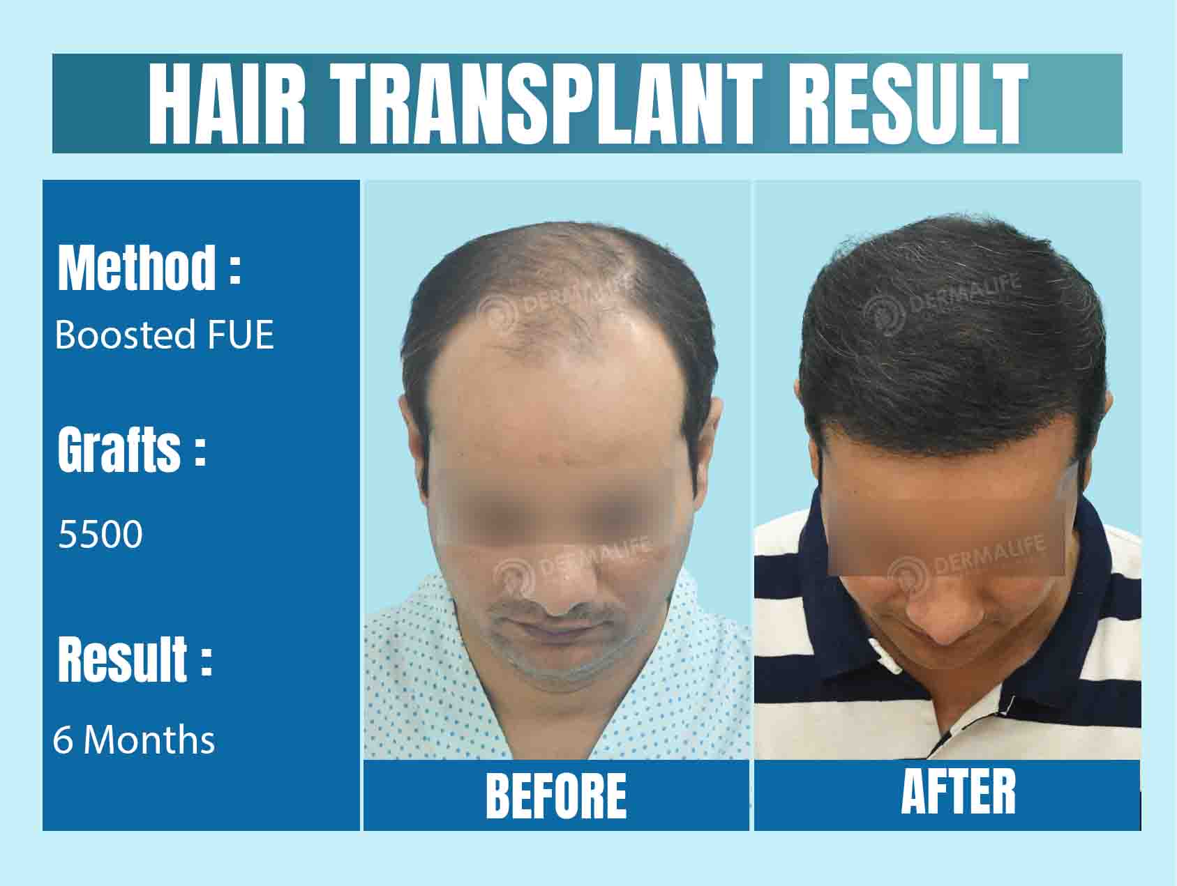 Best Hair Transplant Clinic in Delhi