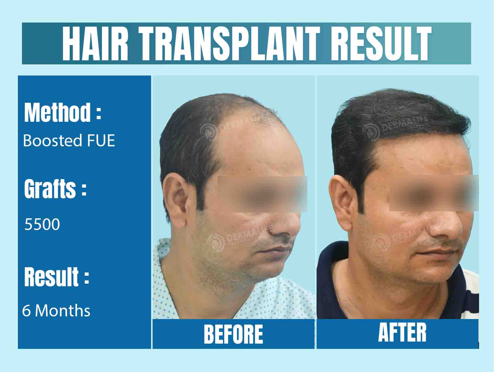 Best Hair Transplant Clinic in Delhi