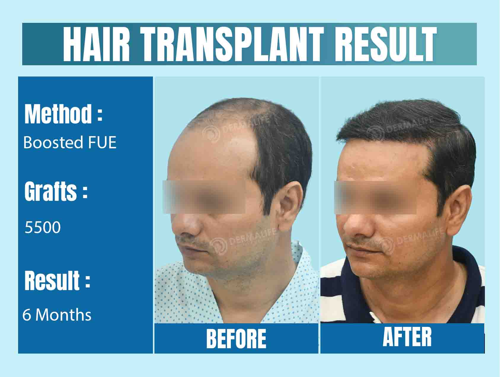Best Hair Transplant Clinic in Delhi