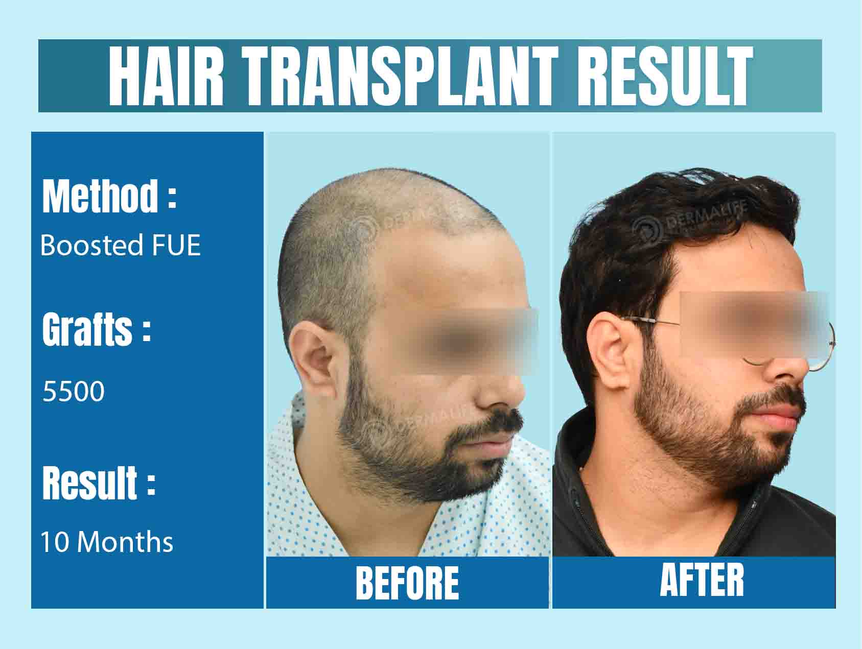 Best Hair Transplant Clinic in Delhi NCR, India