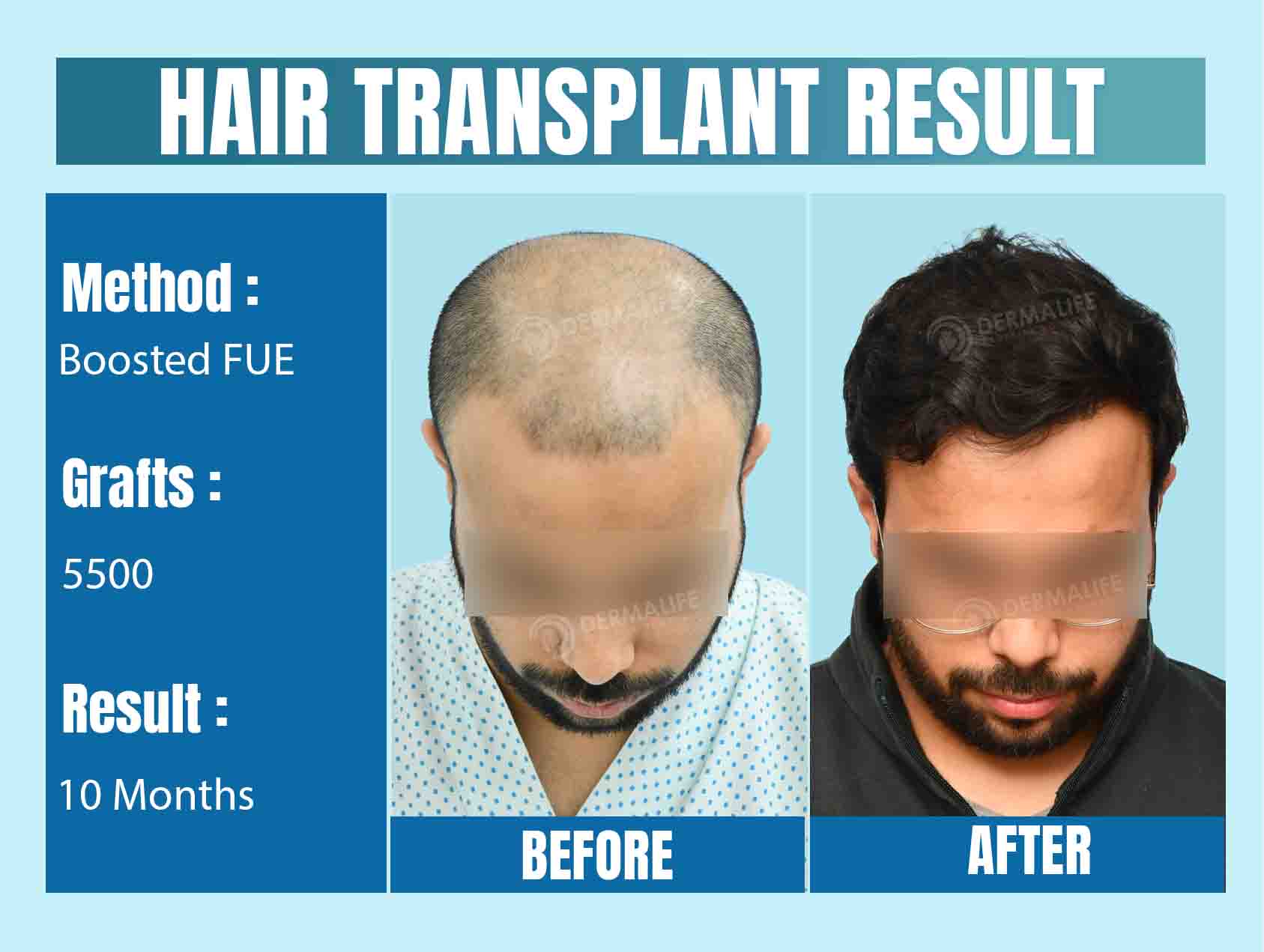 Best Hair Transplant Clinic in Delhi NCR, India