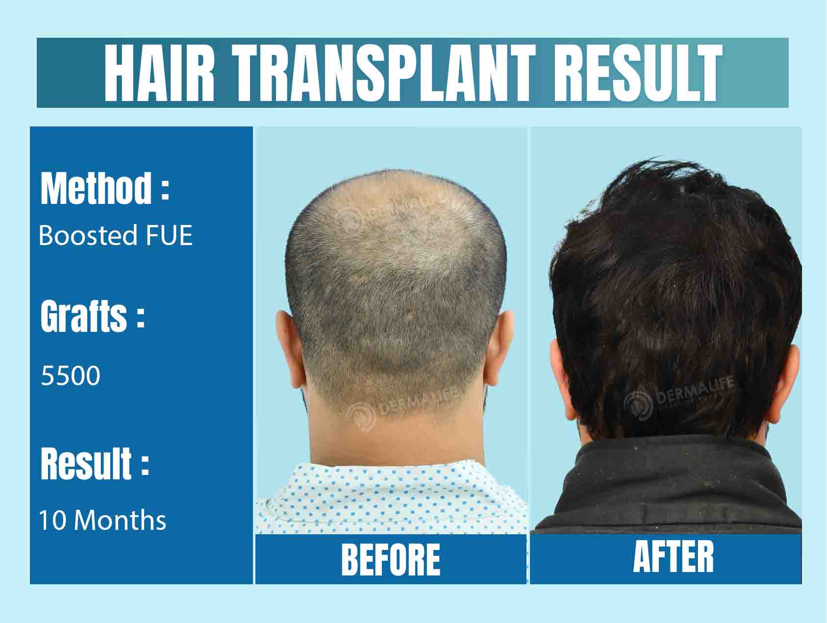 Best Hair Transplant Clinic in Delhi NCR, India
