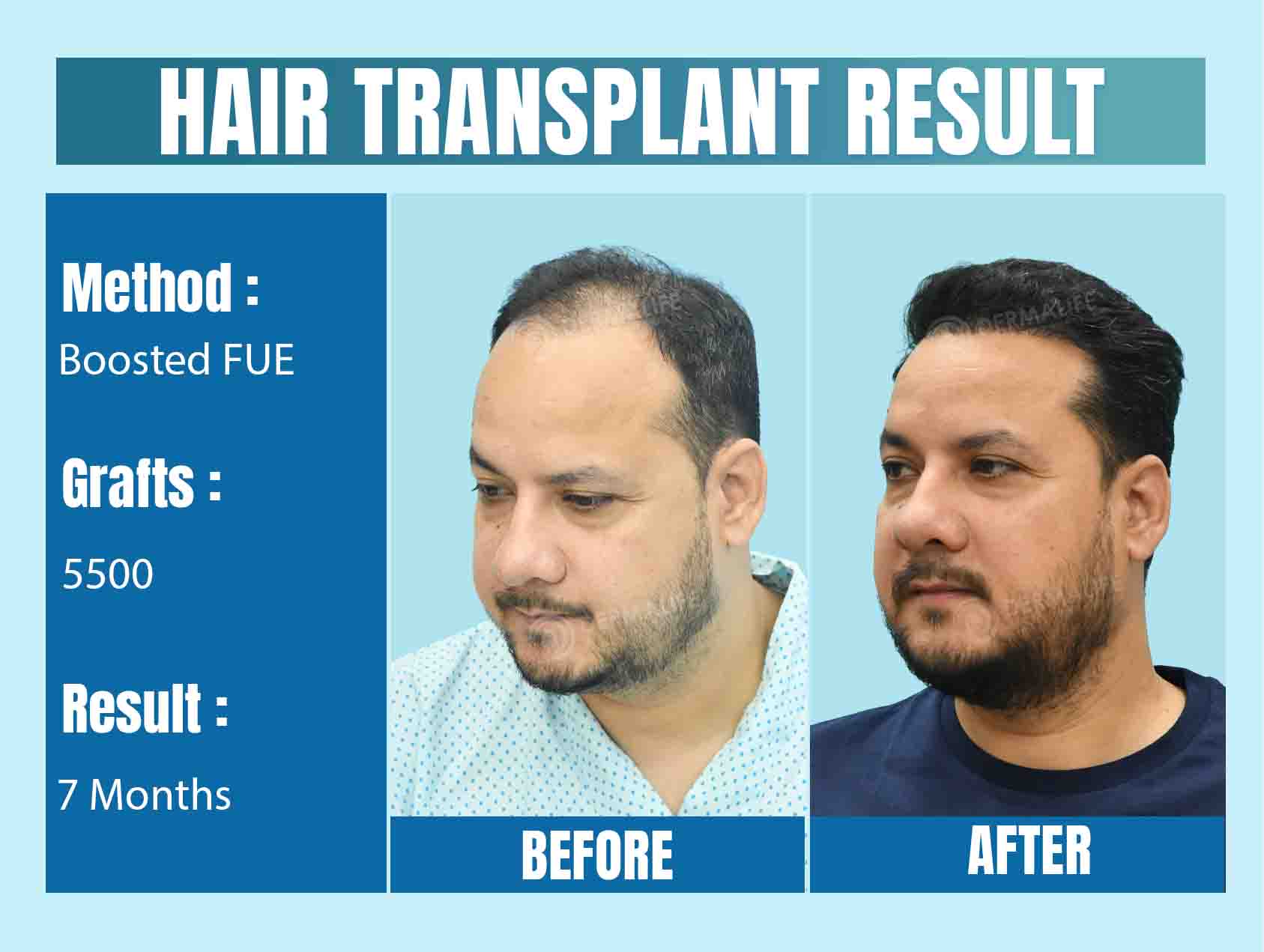 Best Hair Transplant Clinic in India