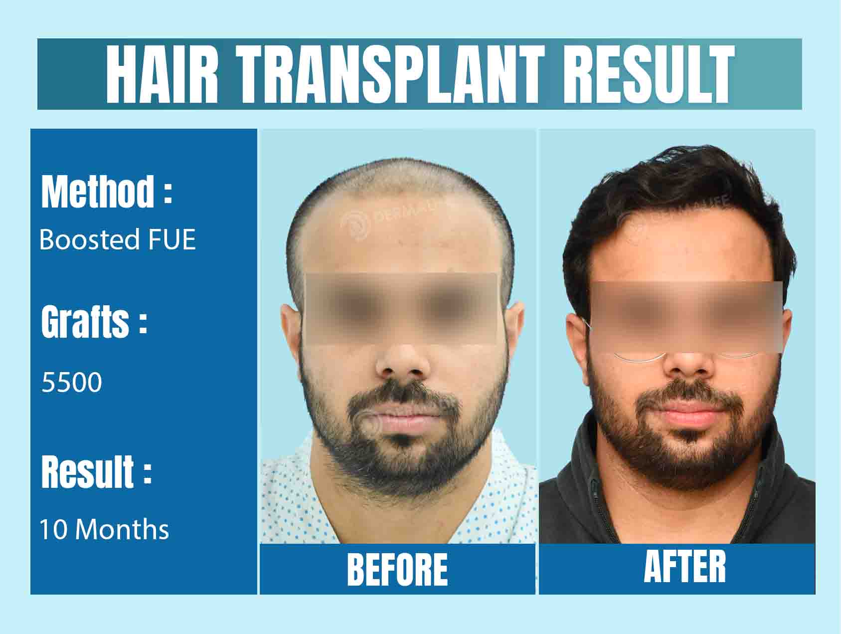 Best Hair Transplant Clinic in Delhi NCR, India