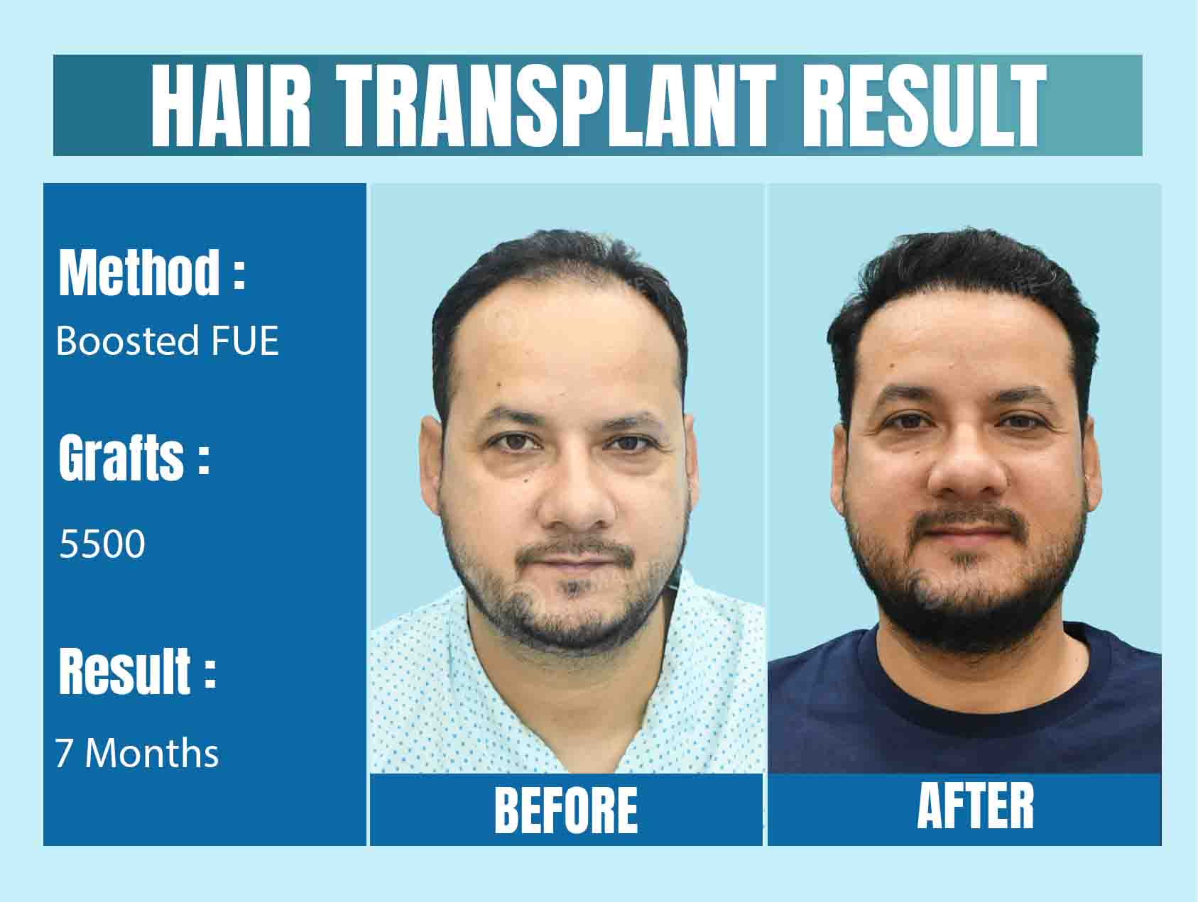 hair Transplant Before & After
