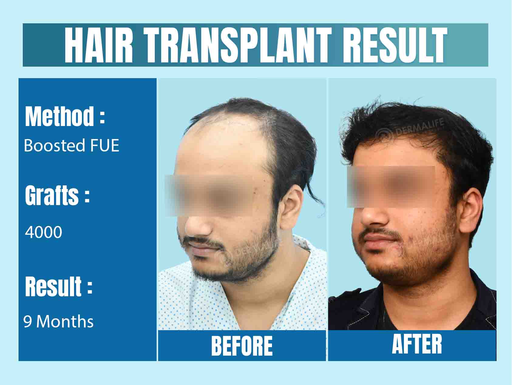 Best Hair Transplant Cost in Noida