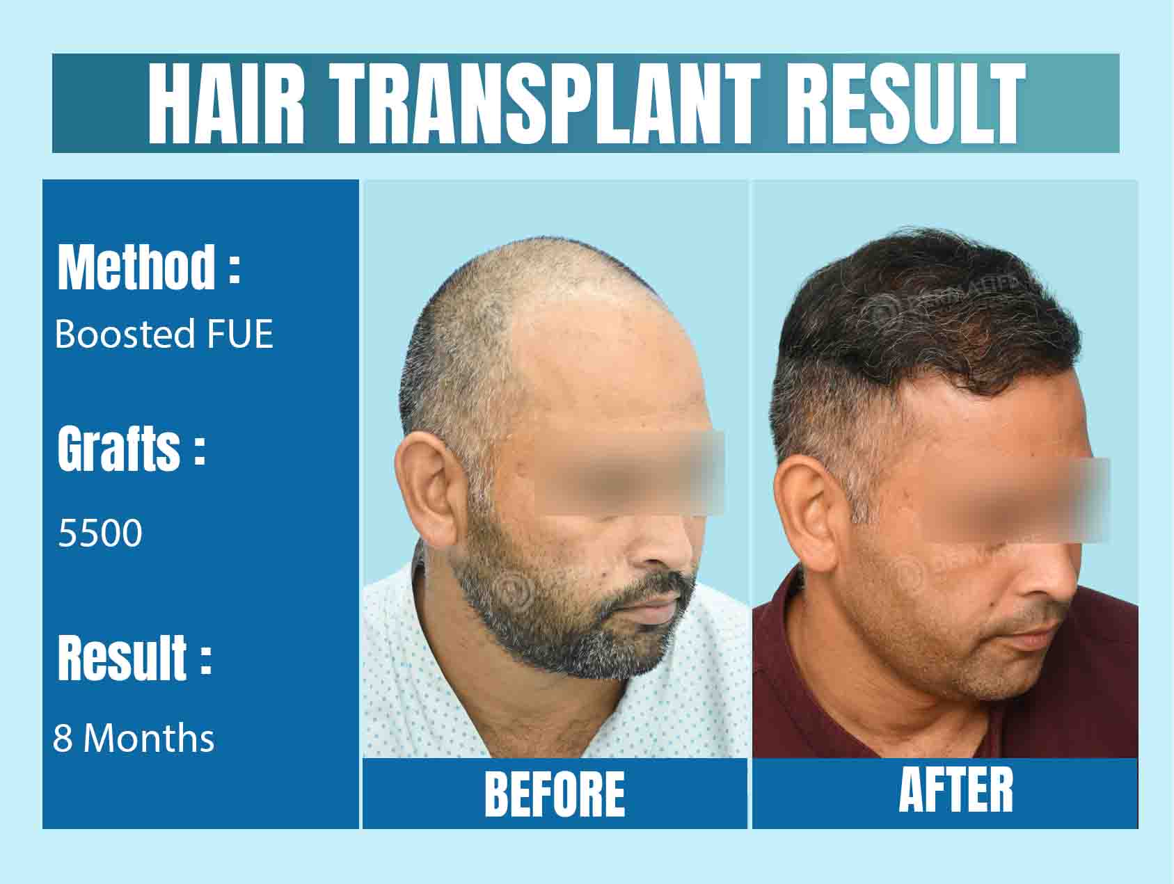Best Hair Transplant Cost in Delhi