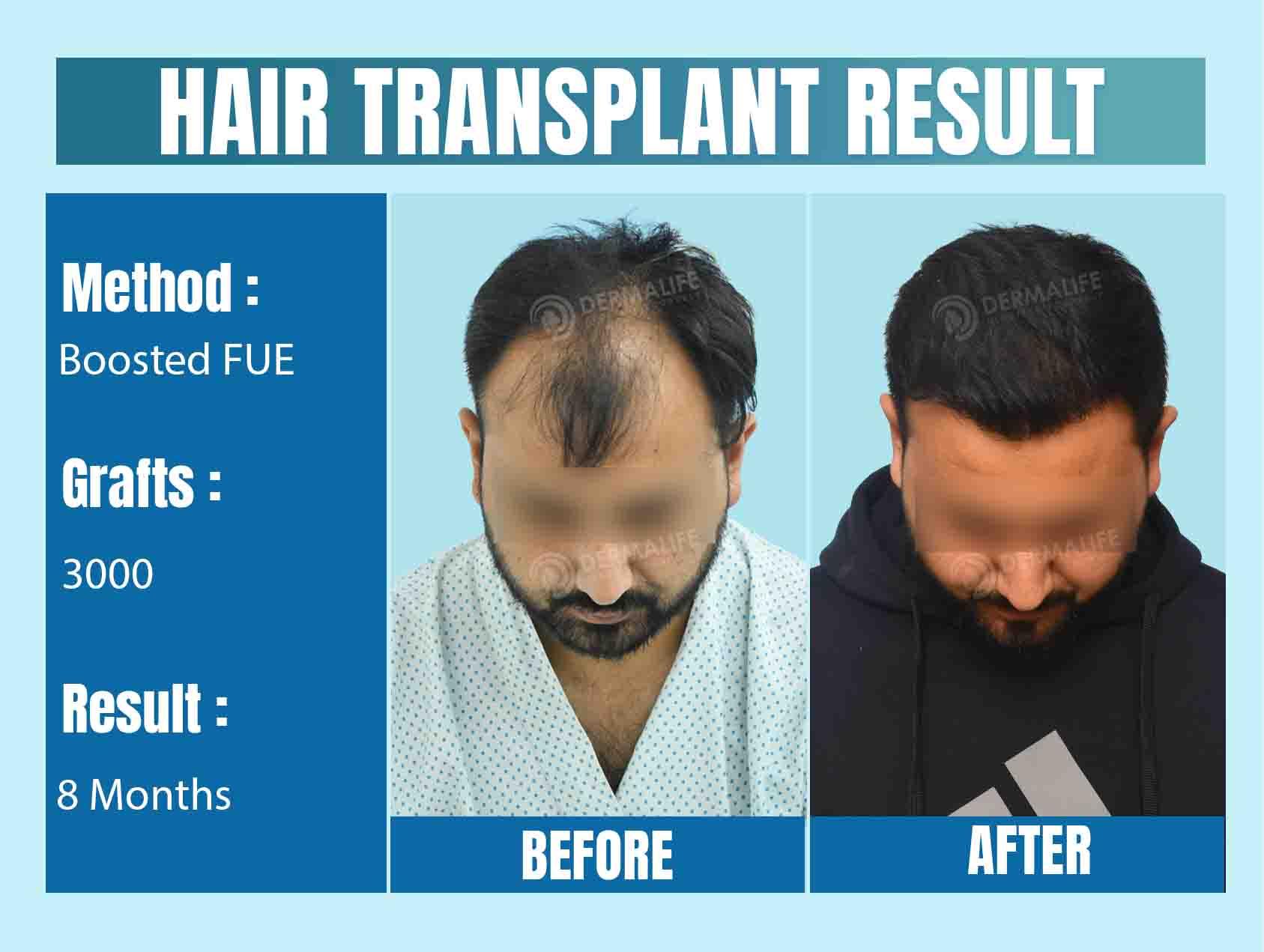 Best Hair Transplant Doctor in Delhi NCR