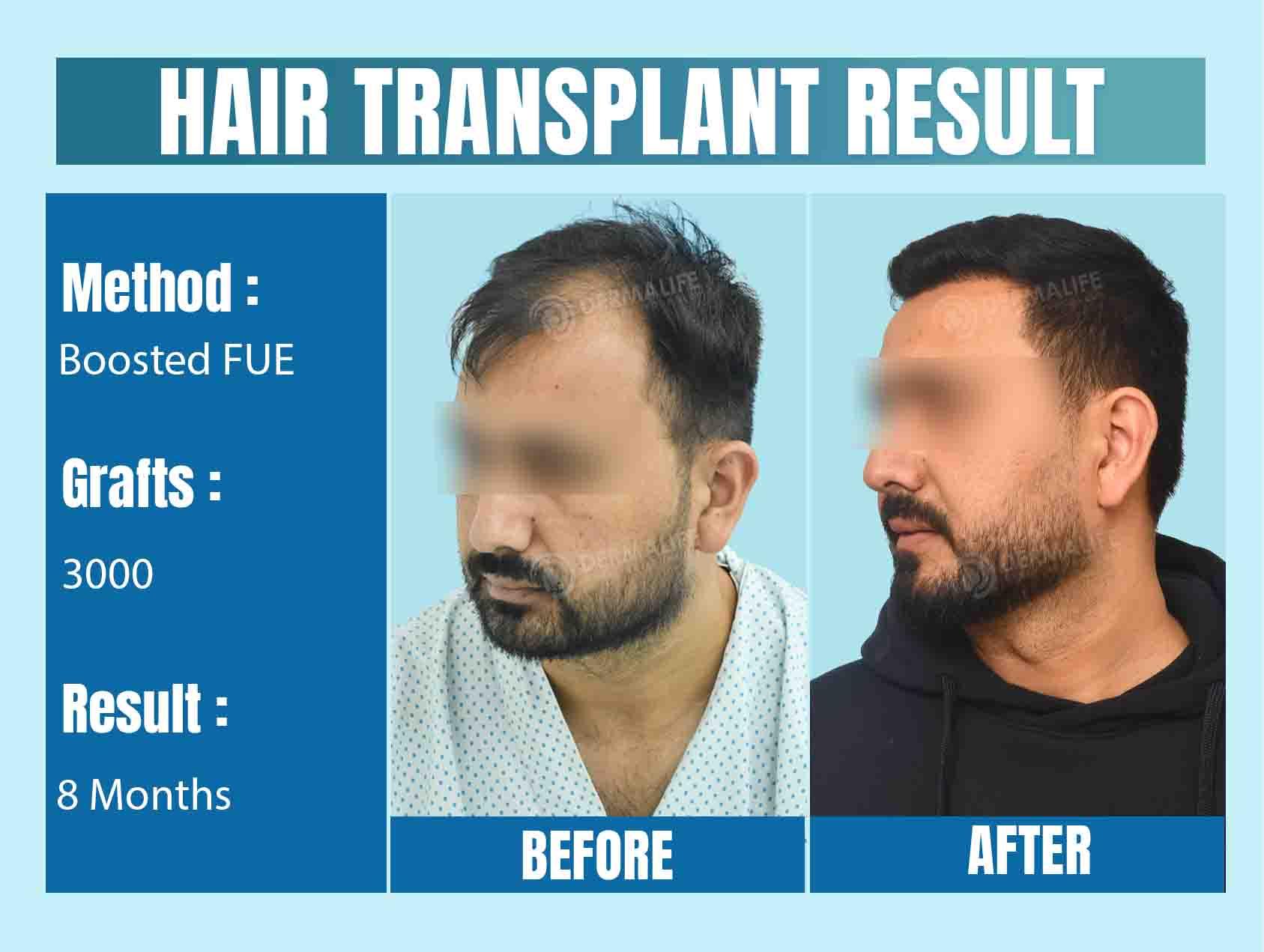 Best Hair Transplant Doctor in Delhi NCR