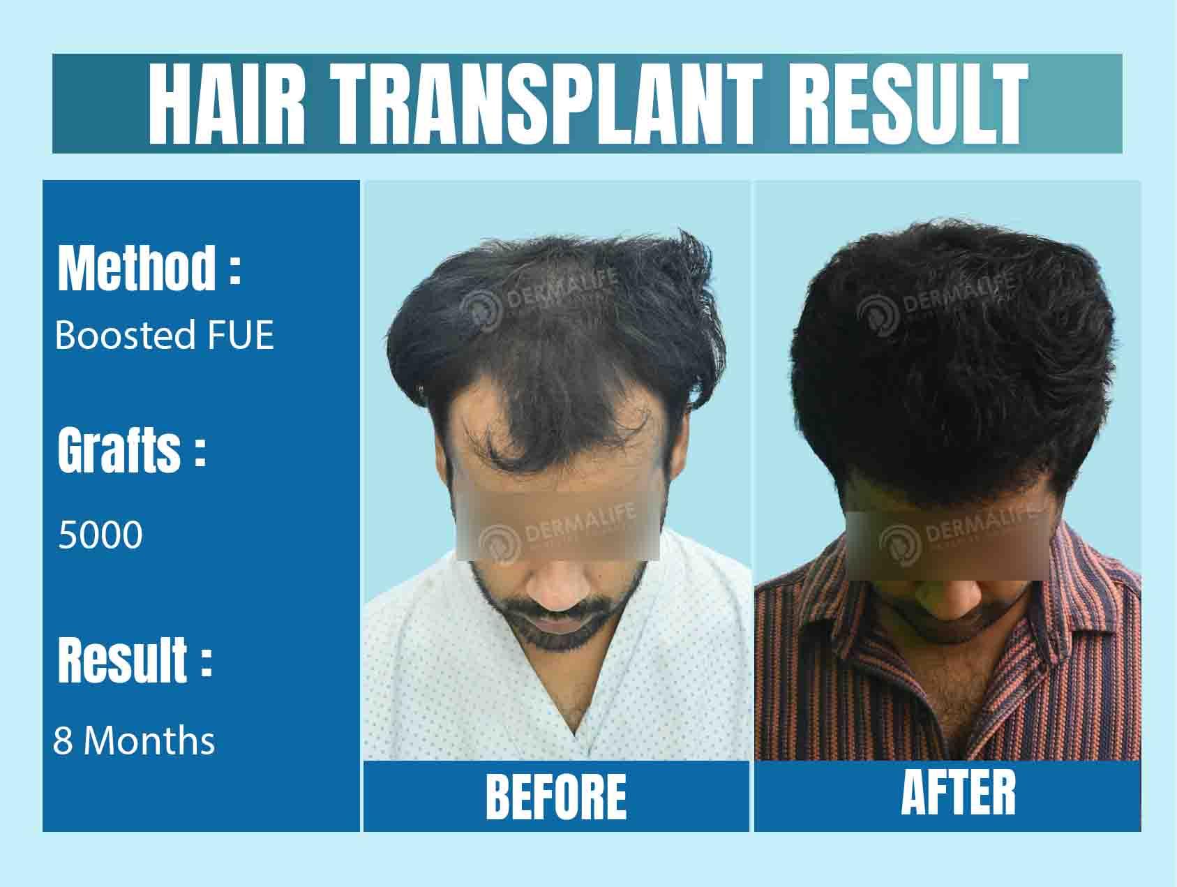 Best Hair Transplant Surgeon in Delhi NCR