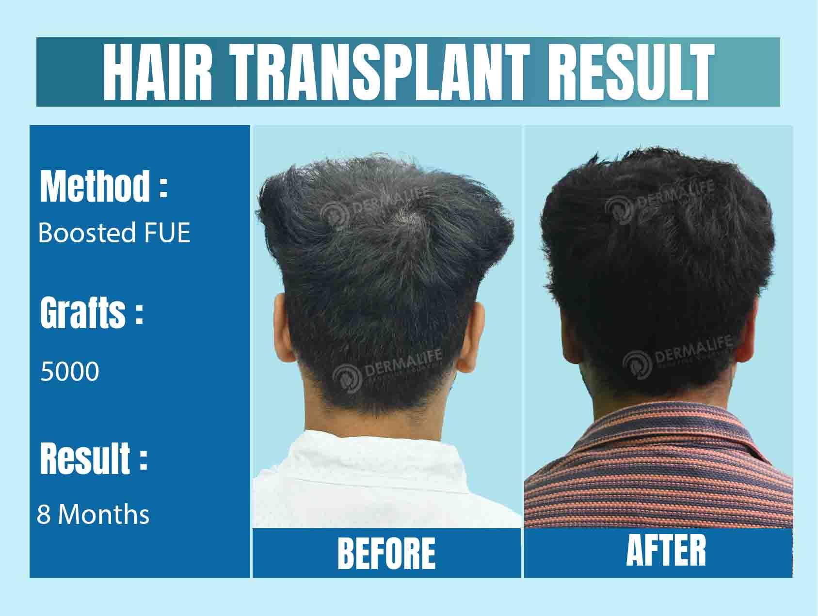 Best Hair Transplant Surgeon in Delhi NCR