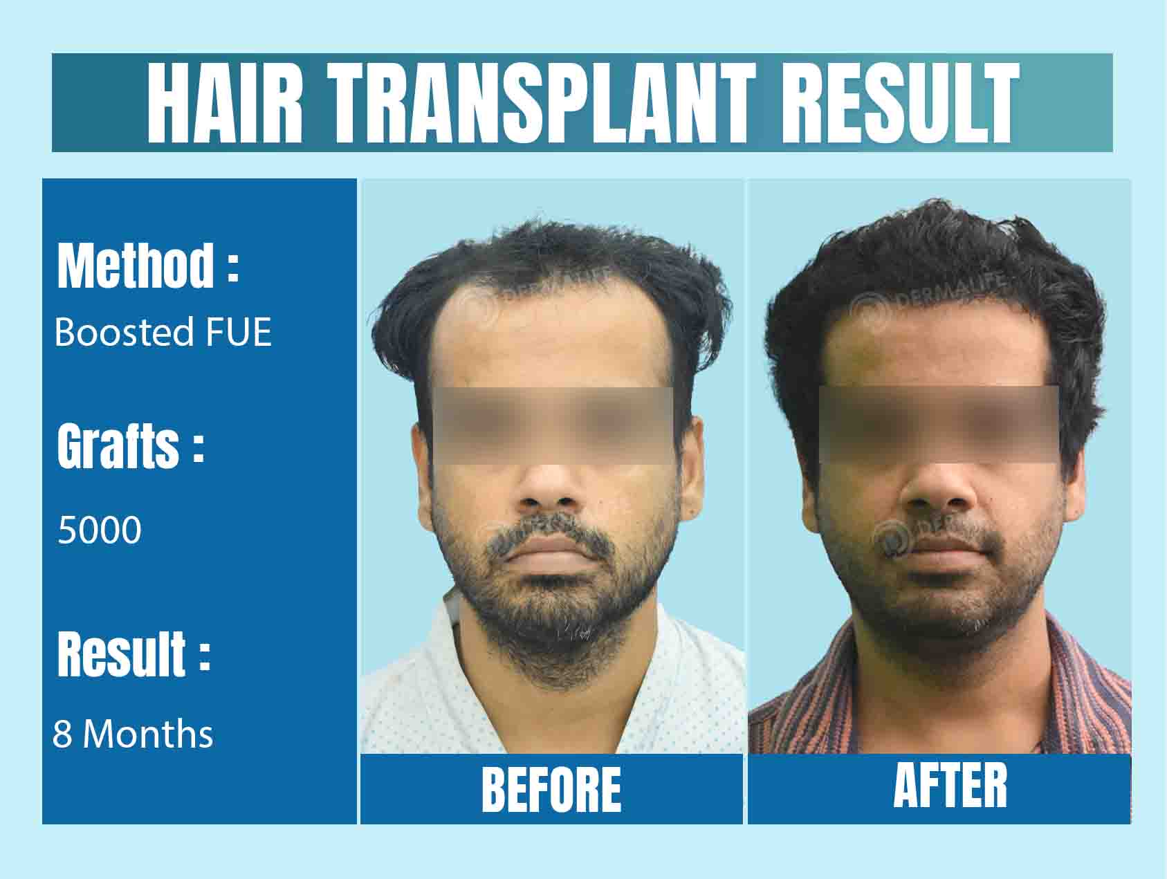 Best Hair Transplant Surgeon in Delhi NCR