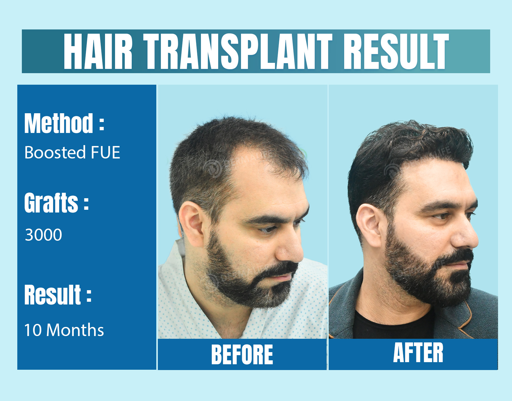 Best Hair Transplant clinic in Delhi