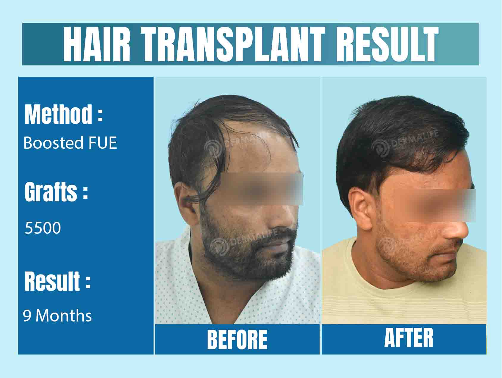 Hair Transplant Result in Delhi