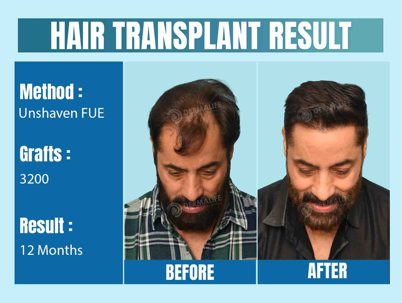 Long hair transplant in Delhi