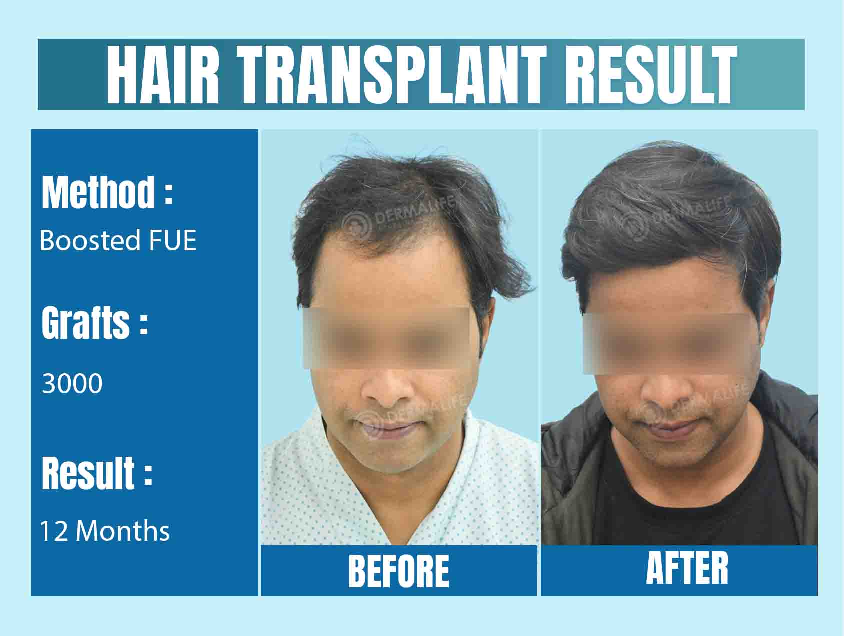 3000 grafts hair transplant cost in Delhi