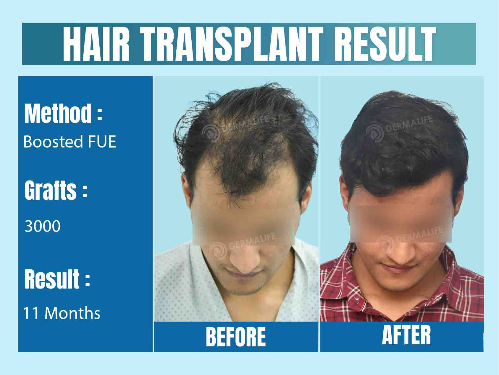 Best hair transplant clinic in Delhi 