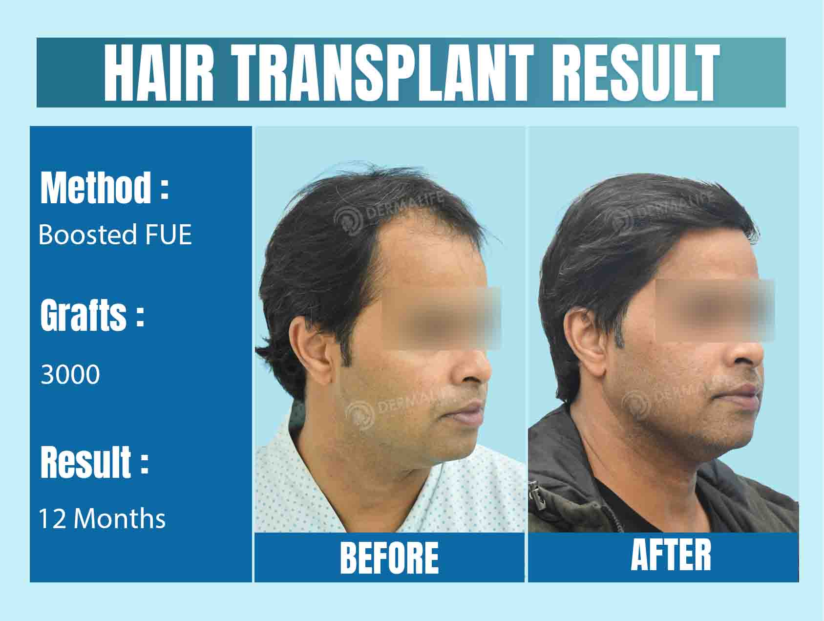 3000 grafts hair transplant cost in Delhi
