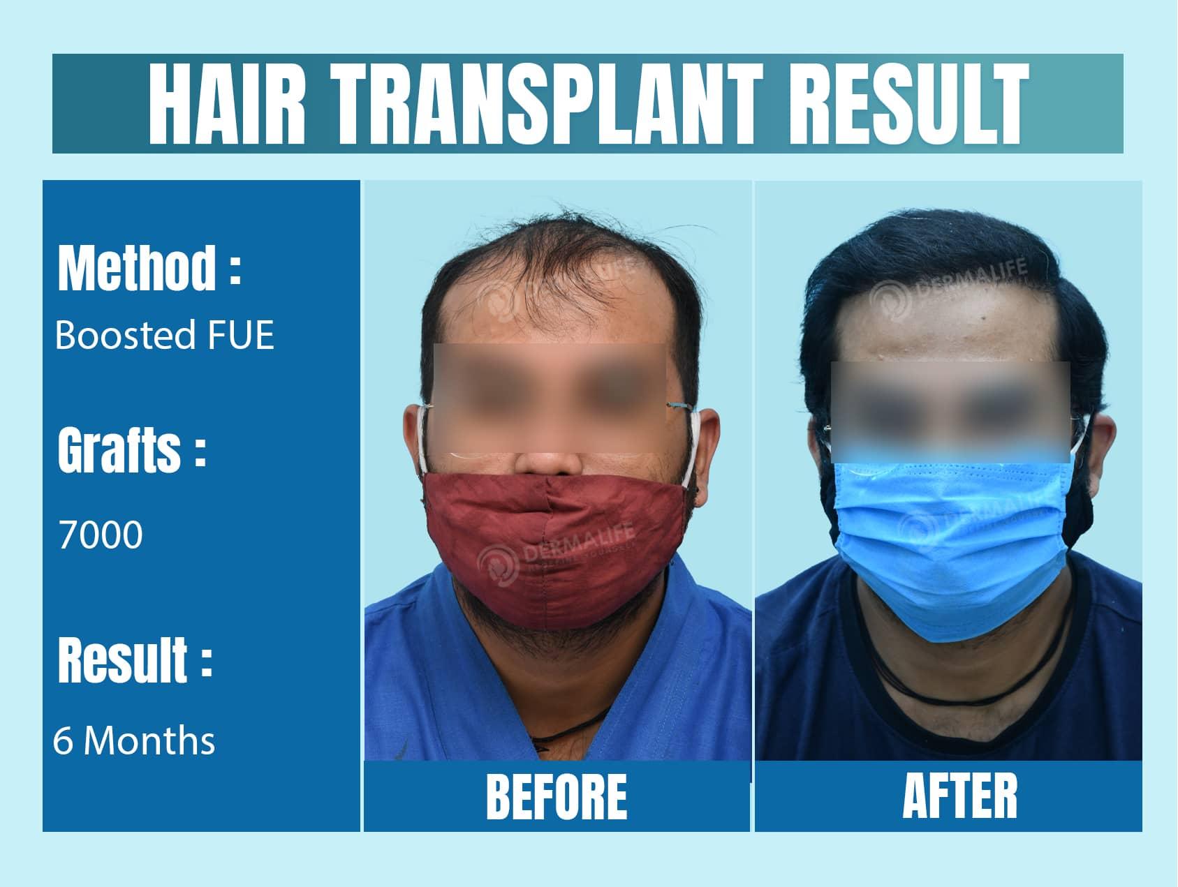 Best hair transplant clinic in delhi