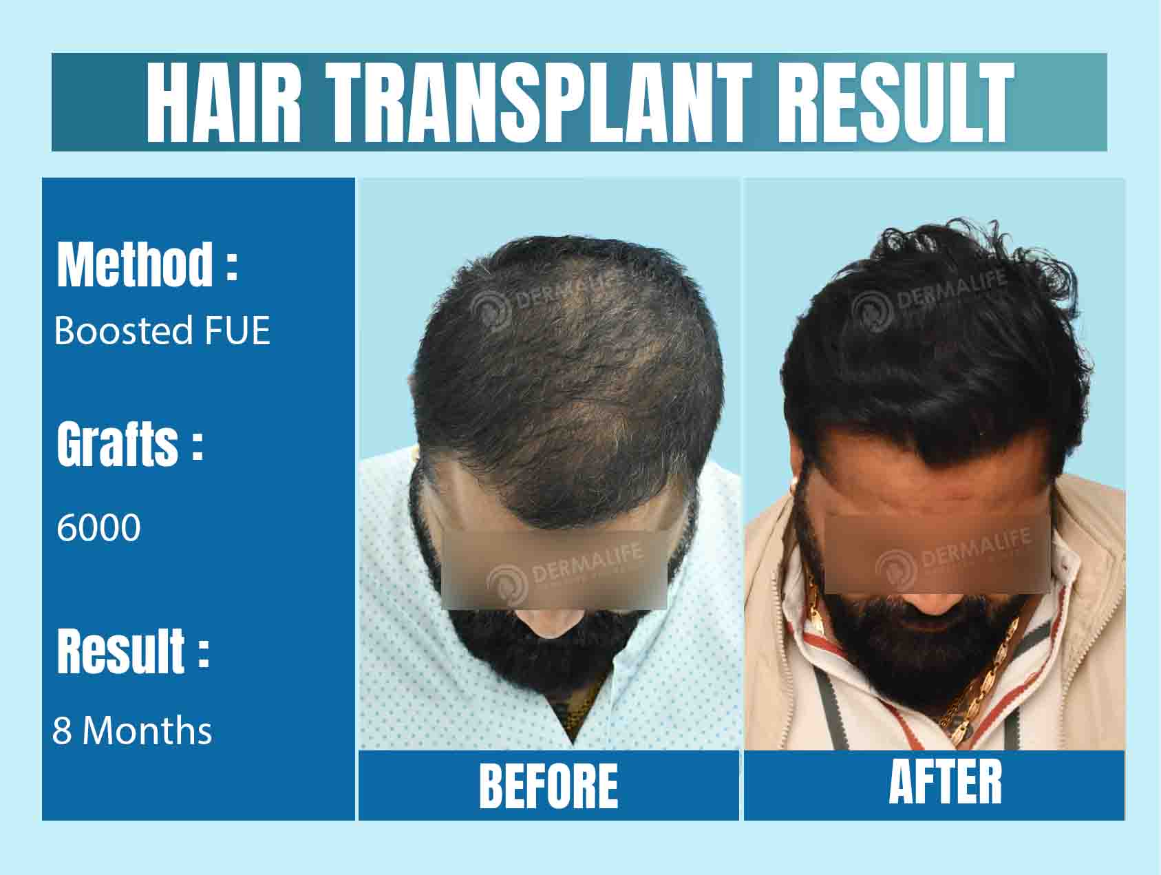 Top Hair Transplant Surgeon in Delhi