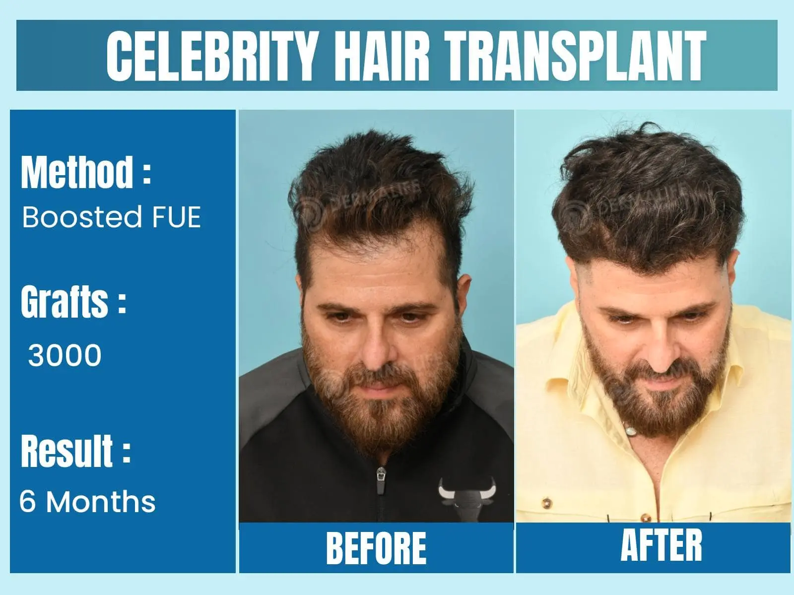 Before and After Results of Hair Transplant for Celebrity Hair Transplant