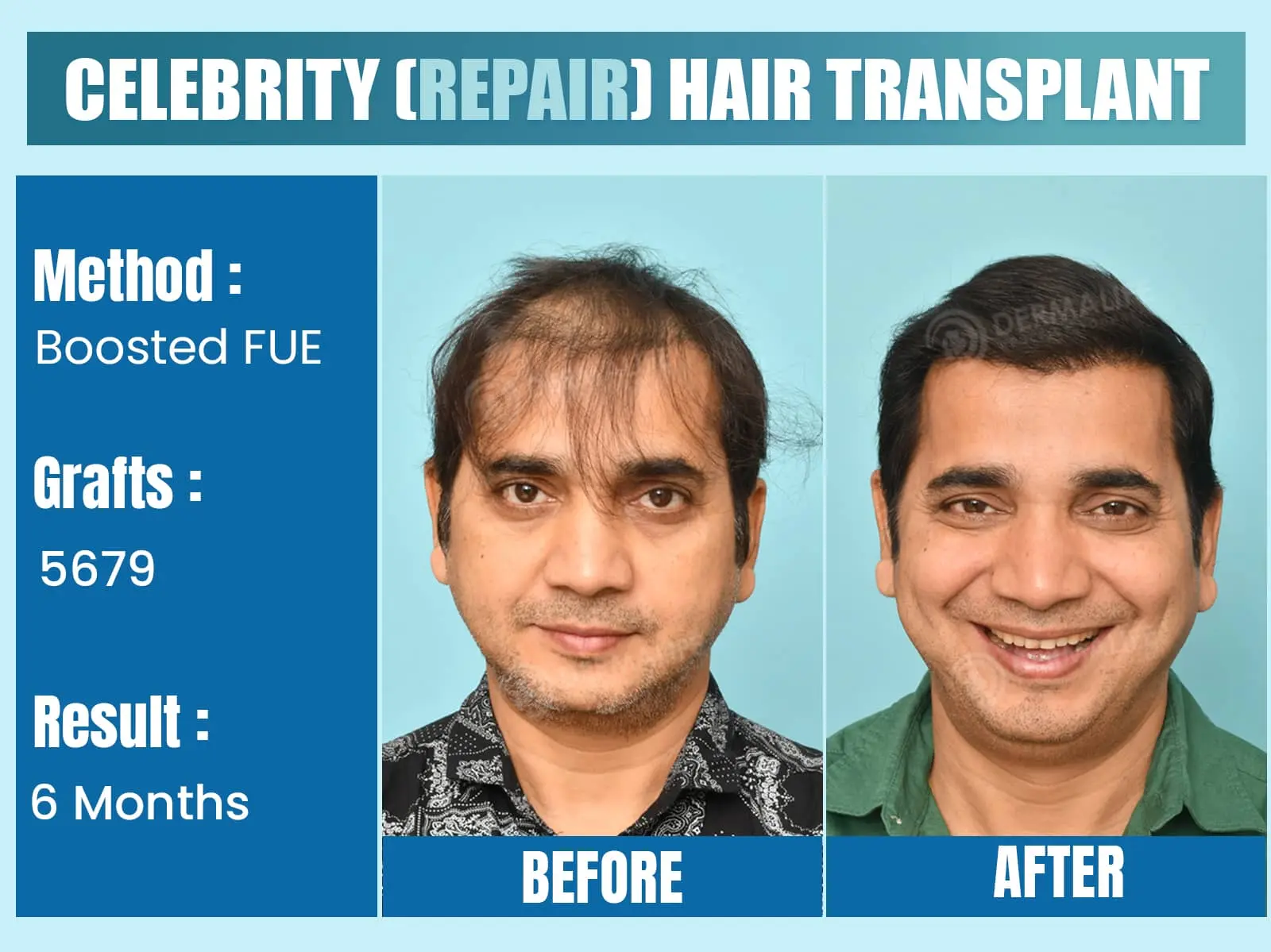 Before and After Results of Hair Transplant for Celebrity Hair Transplant