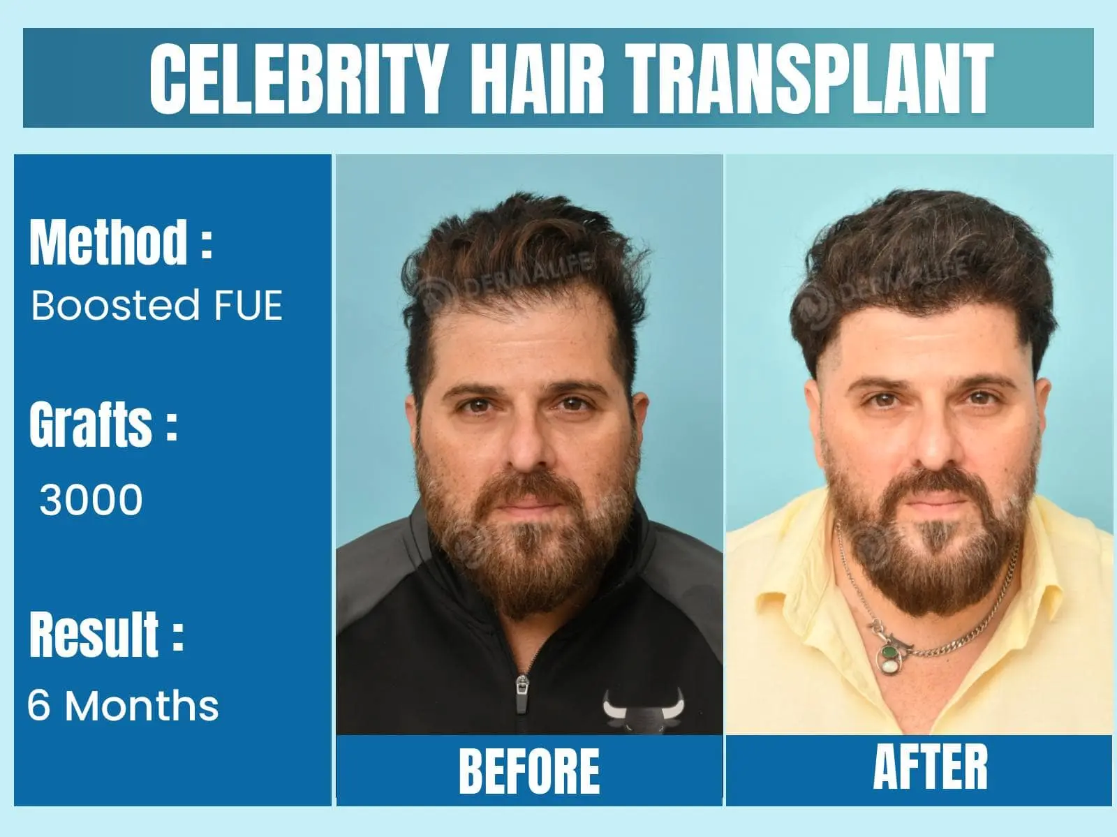 Before and After Results of Hair Transplant for Front