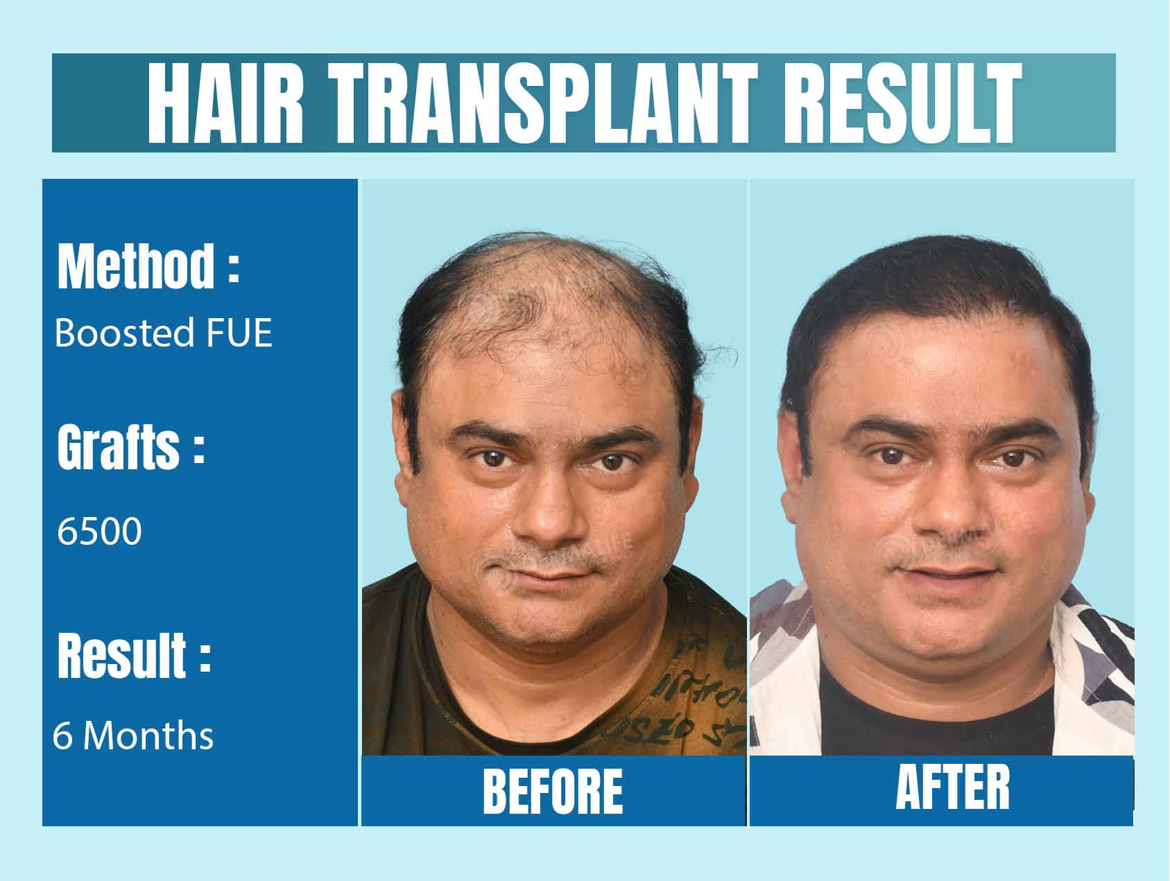 Celebrity Hair Transplant Before And After Images