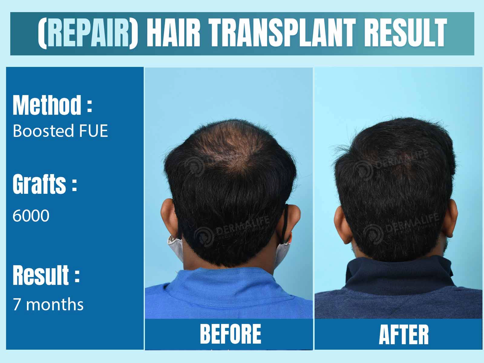 Before and After Results of Hair Transplant for Crown