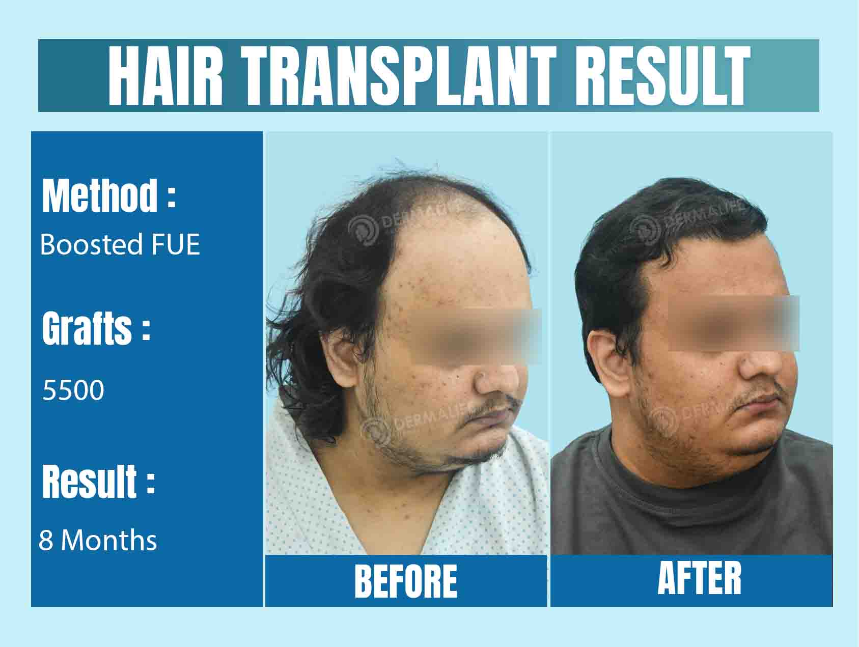 Cost of 5500 Graft Hair Transplant in India