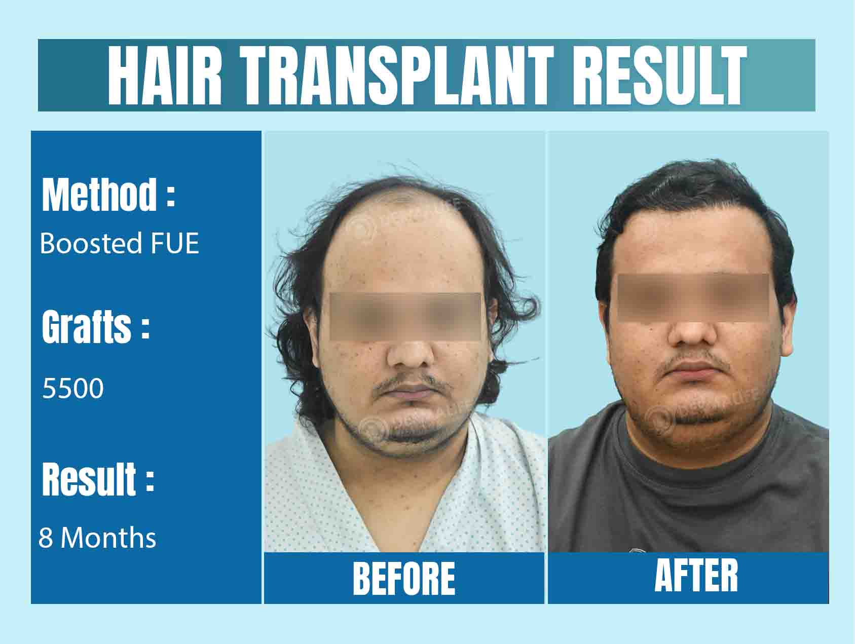 Cost of 5500 Graft Hair Transplant in India