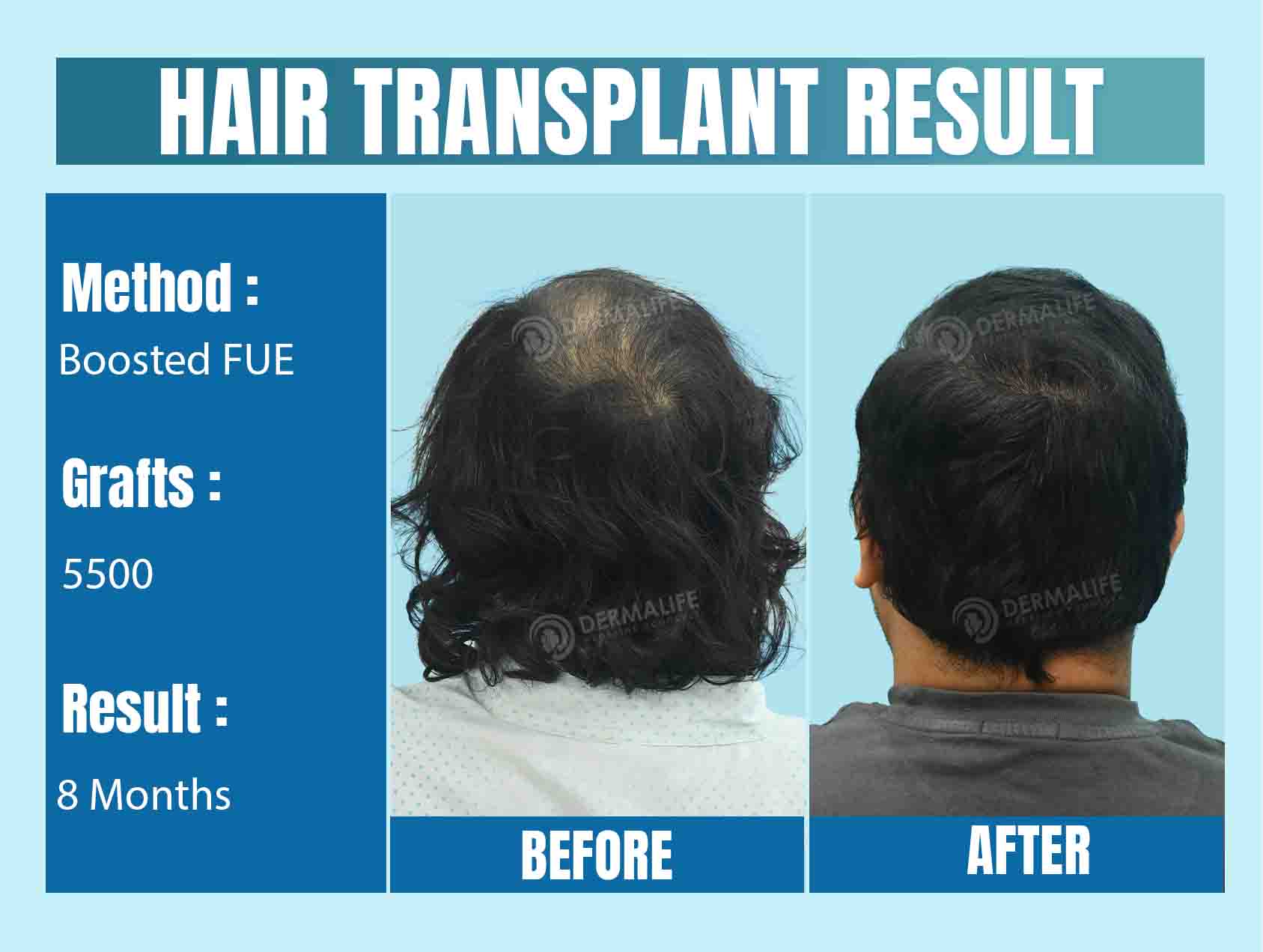 Cost of 5500 Graft Hair Transplant in India