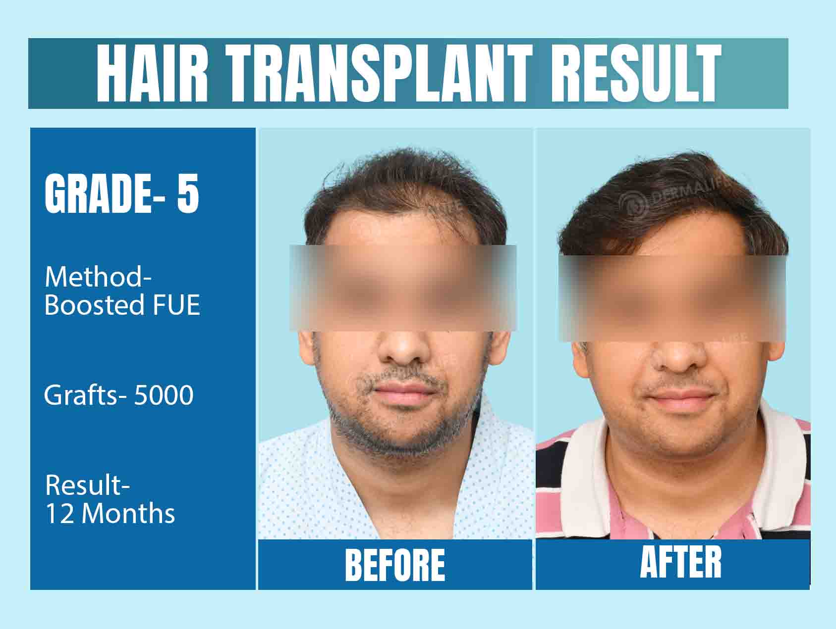 Hair Transplant Results After 12 Months 5000 Grafts with Boosted FUE Technique