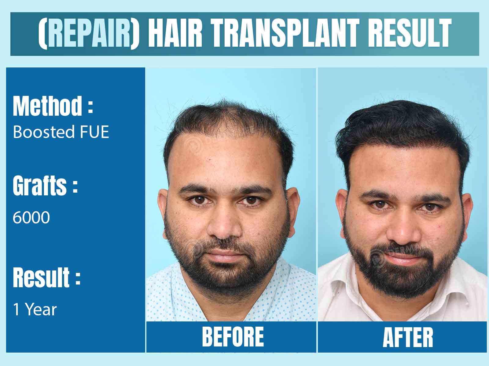 Before and After Results of Hair Transplant for Repair/ Corrective Hair Transplant