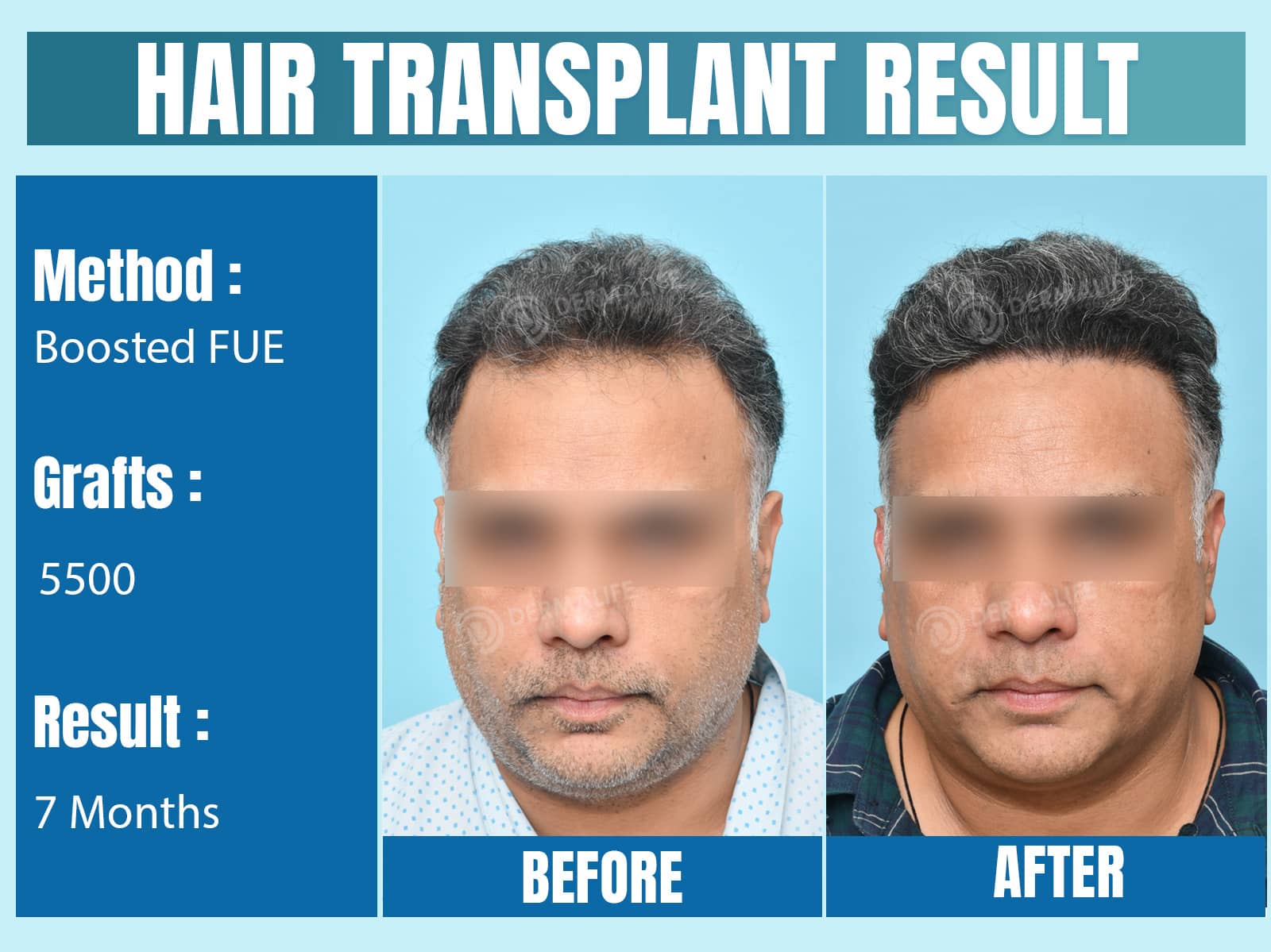 Before and After Results of Hair Transplant for Norwood Grade 5