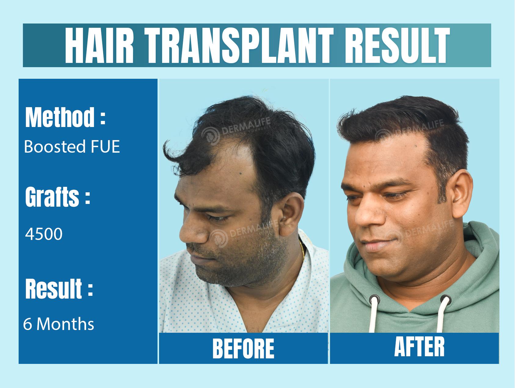 Hair Transplant Before and After Result with 4500 Grafts
