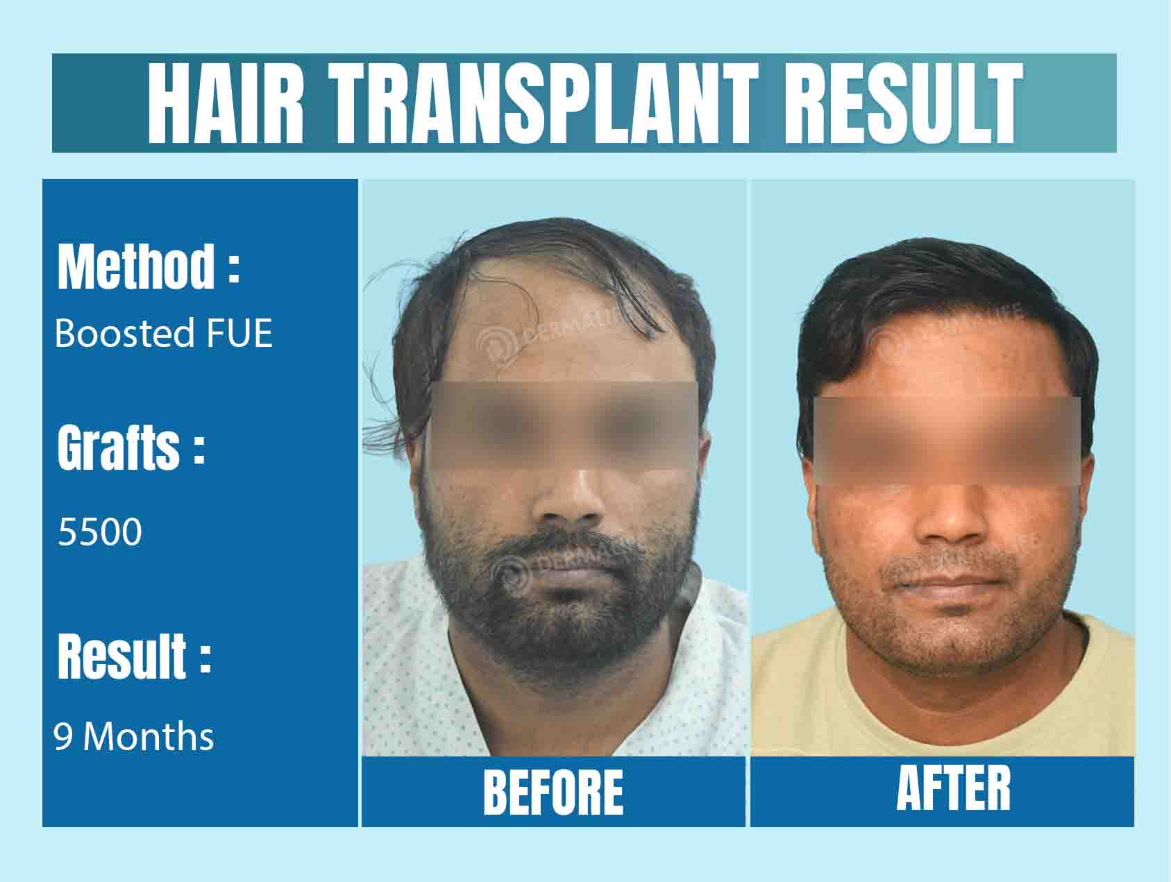 Hair Transplant Before After Result in Delhi