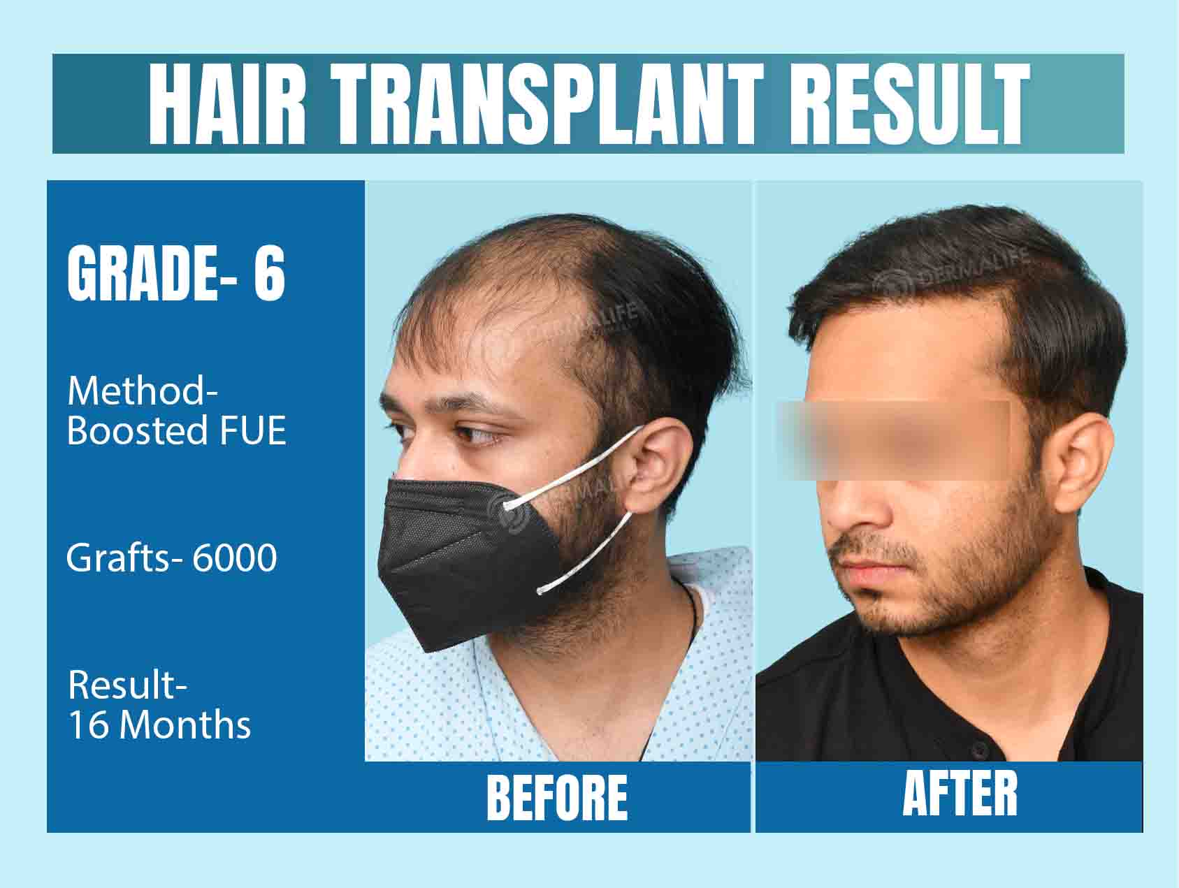 Hair Transplant Before and After Result 16 Month Grade 6 Baldness with 6000 Grafts