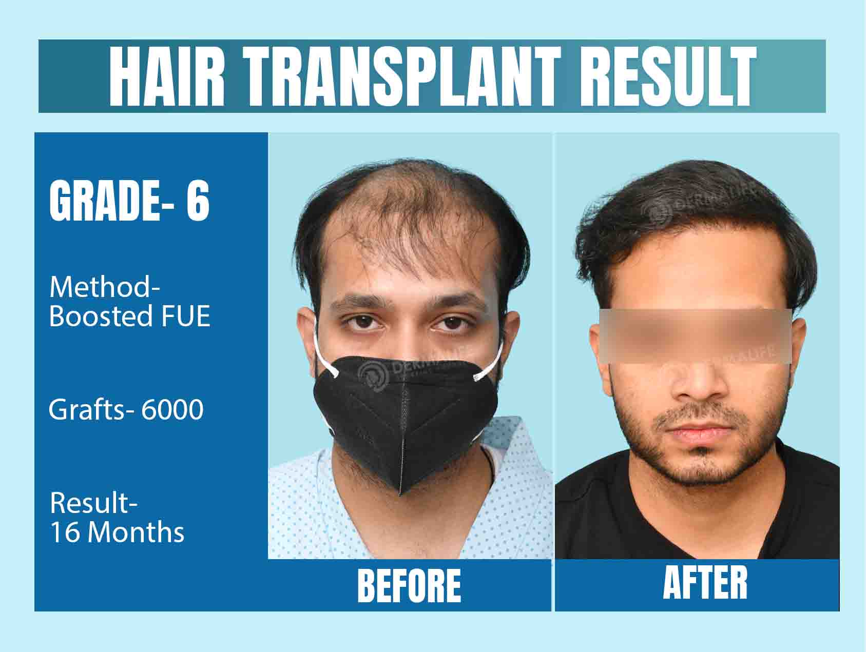 Hair Transplant Before and After Result 16 Month Grade 6 Baldness with 6000 Grafts
