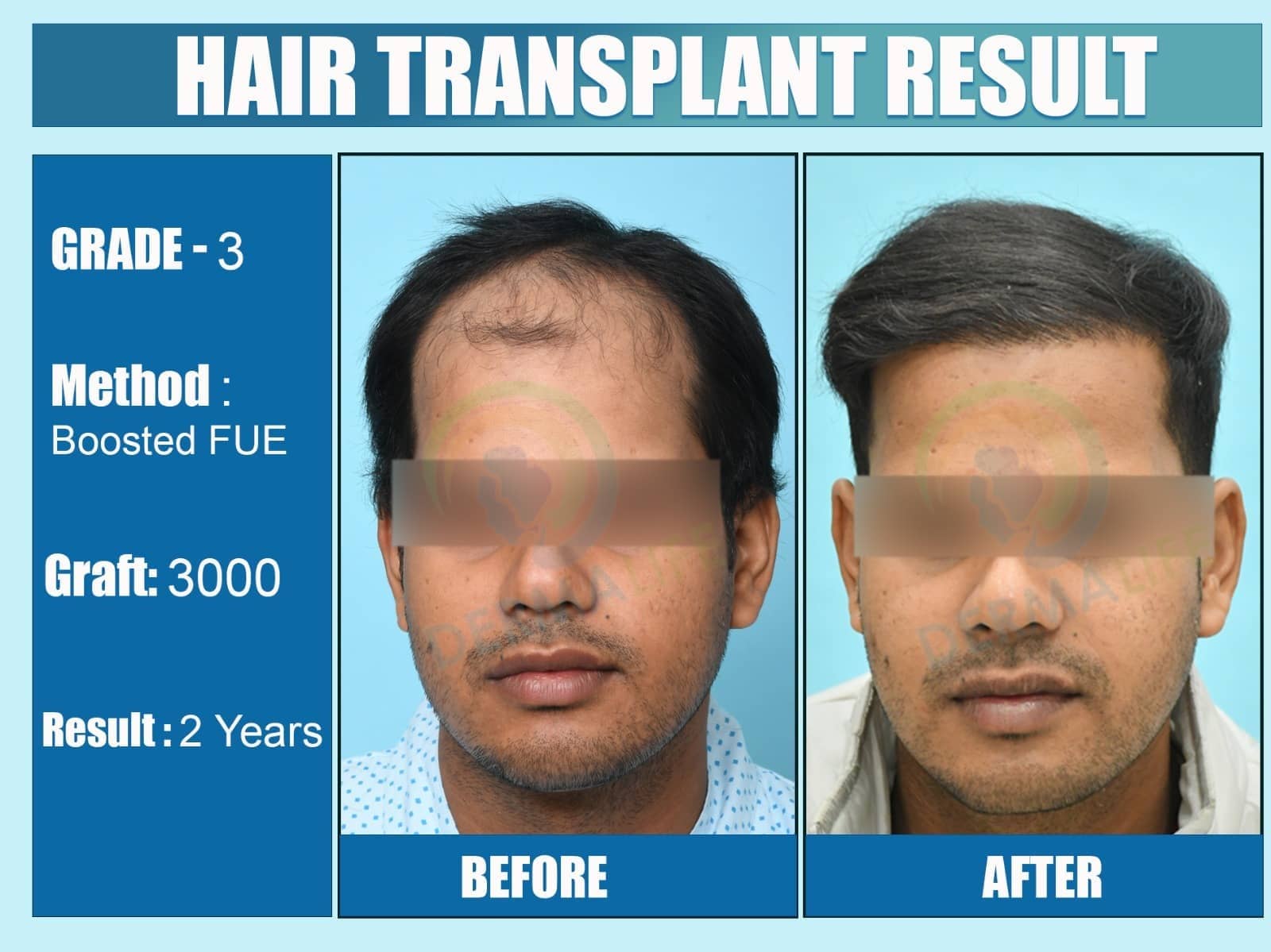 Before and After Results of Hair Transplant for Front