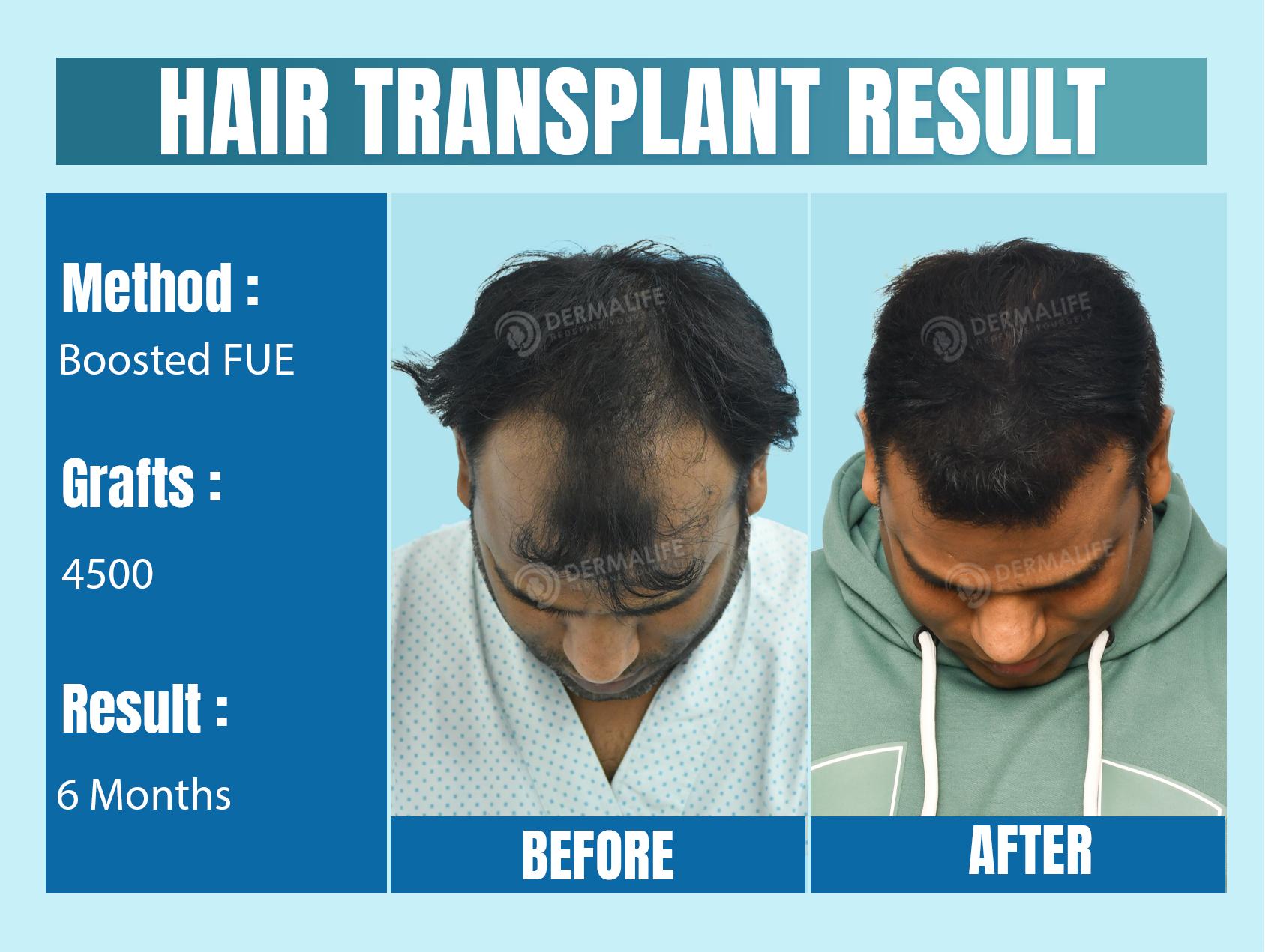 Hair Transplant Before and After Result with 4500 Grafts