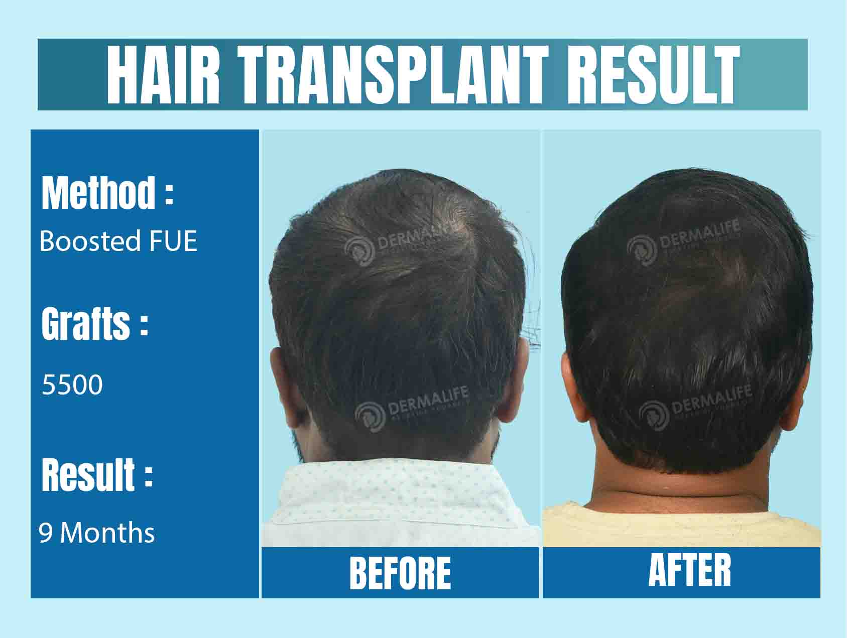 Hair Transplant Before After in Delhi