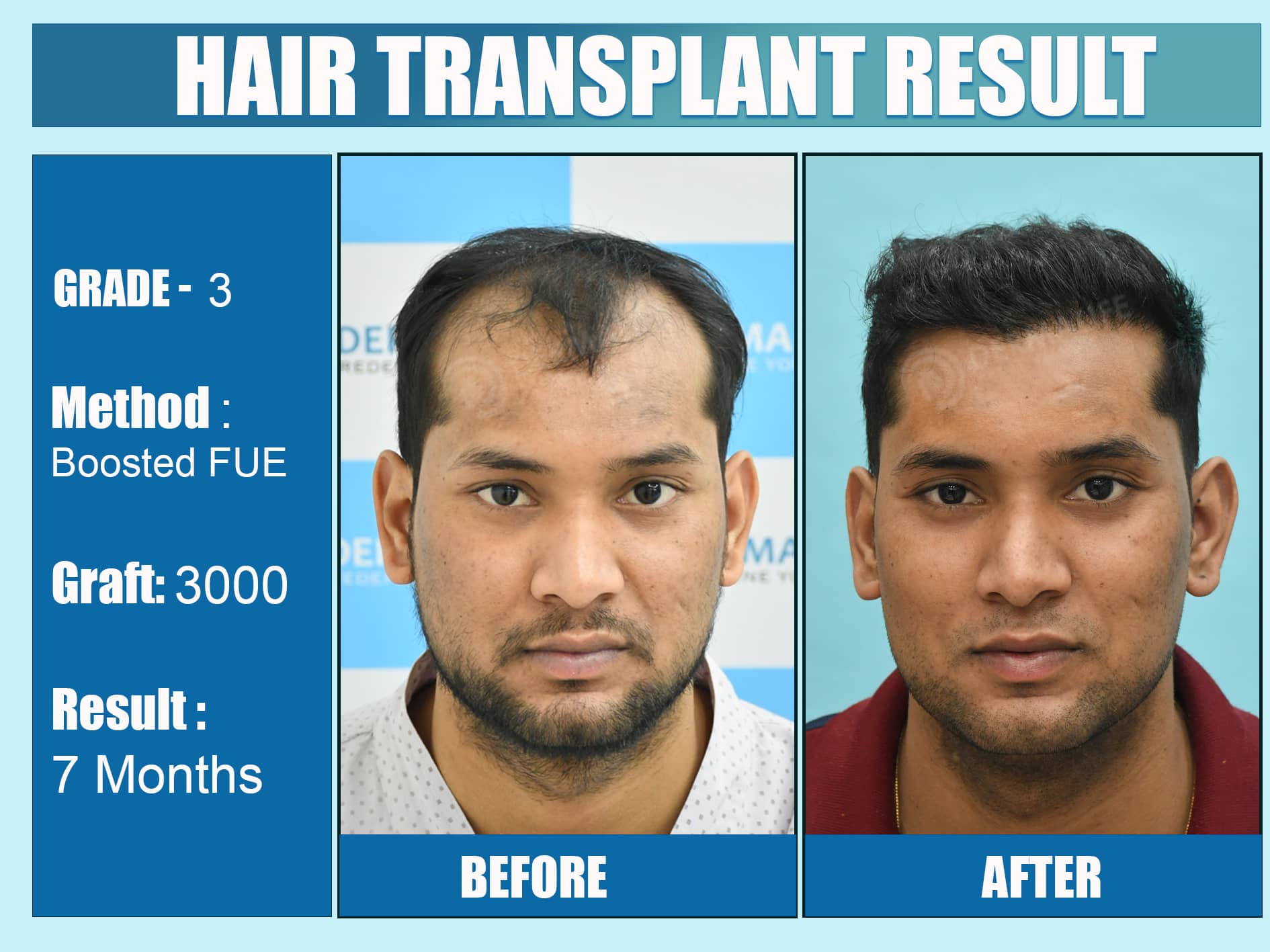 Before and After Results of Hair Transplant for Norwood Grade 3