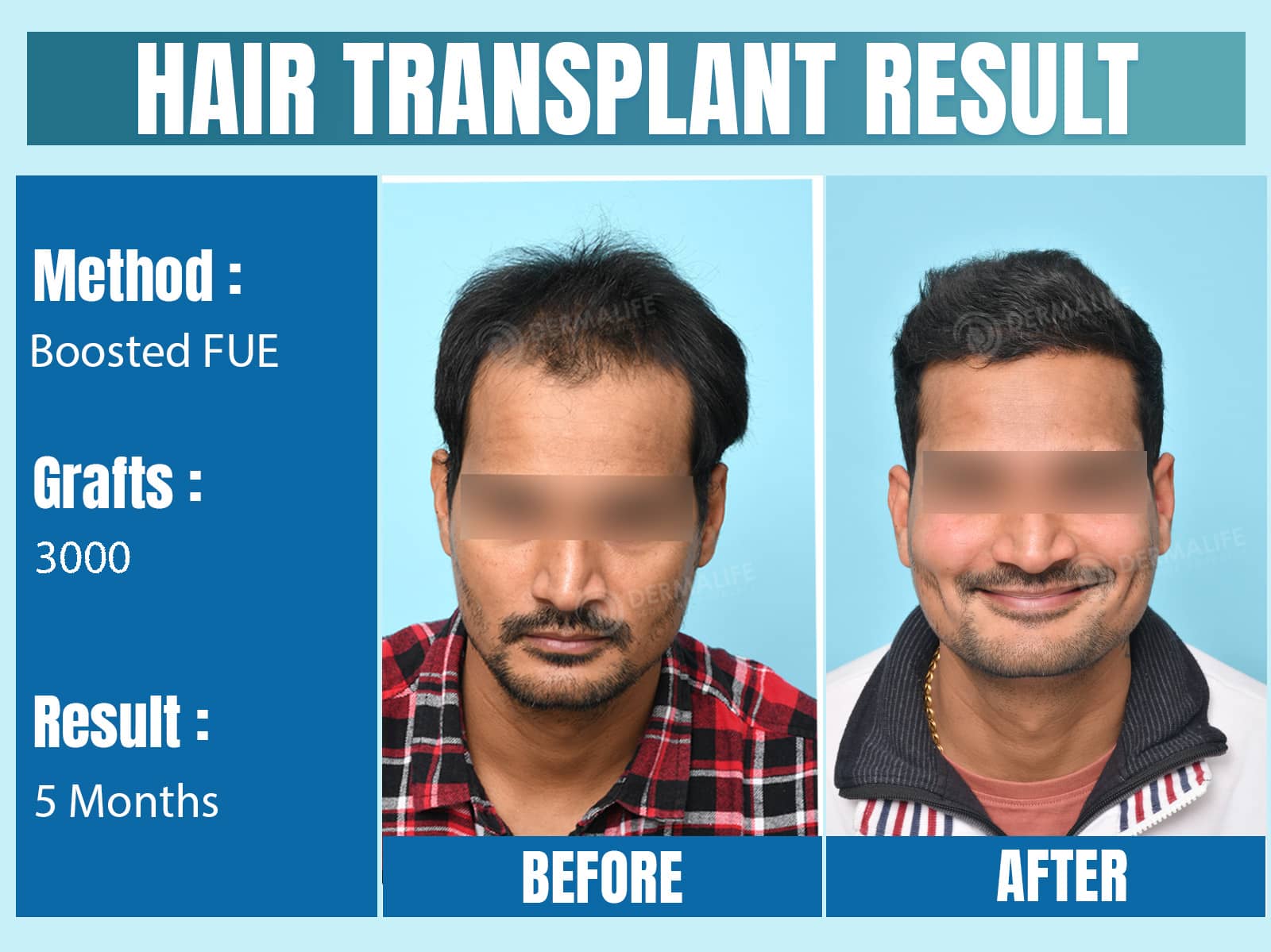 Before and After Results of Hair Transplant for Norwood Grade 3