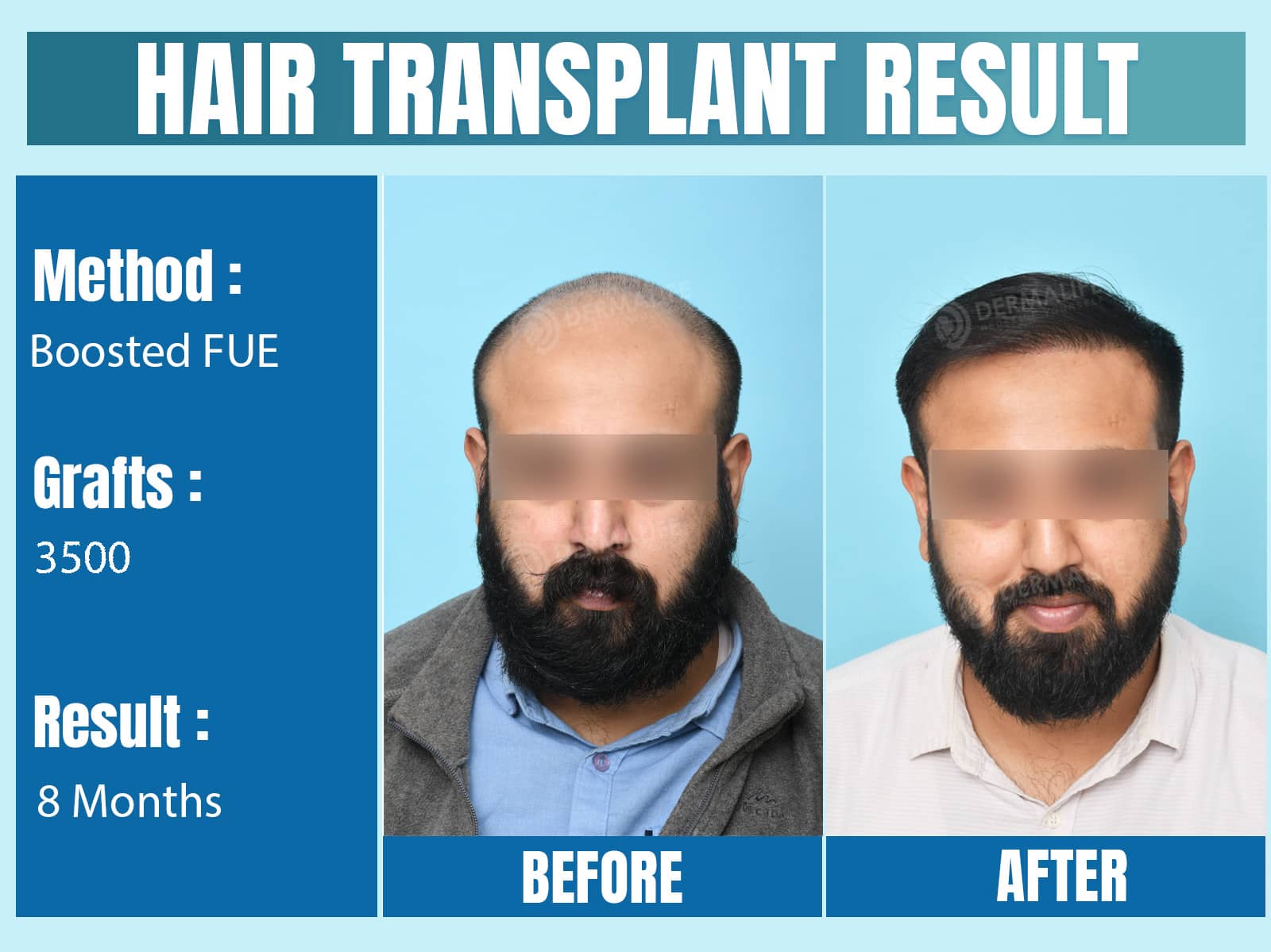 Before and After Results of Hair Transplant for Norwood Grade 3