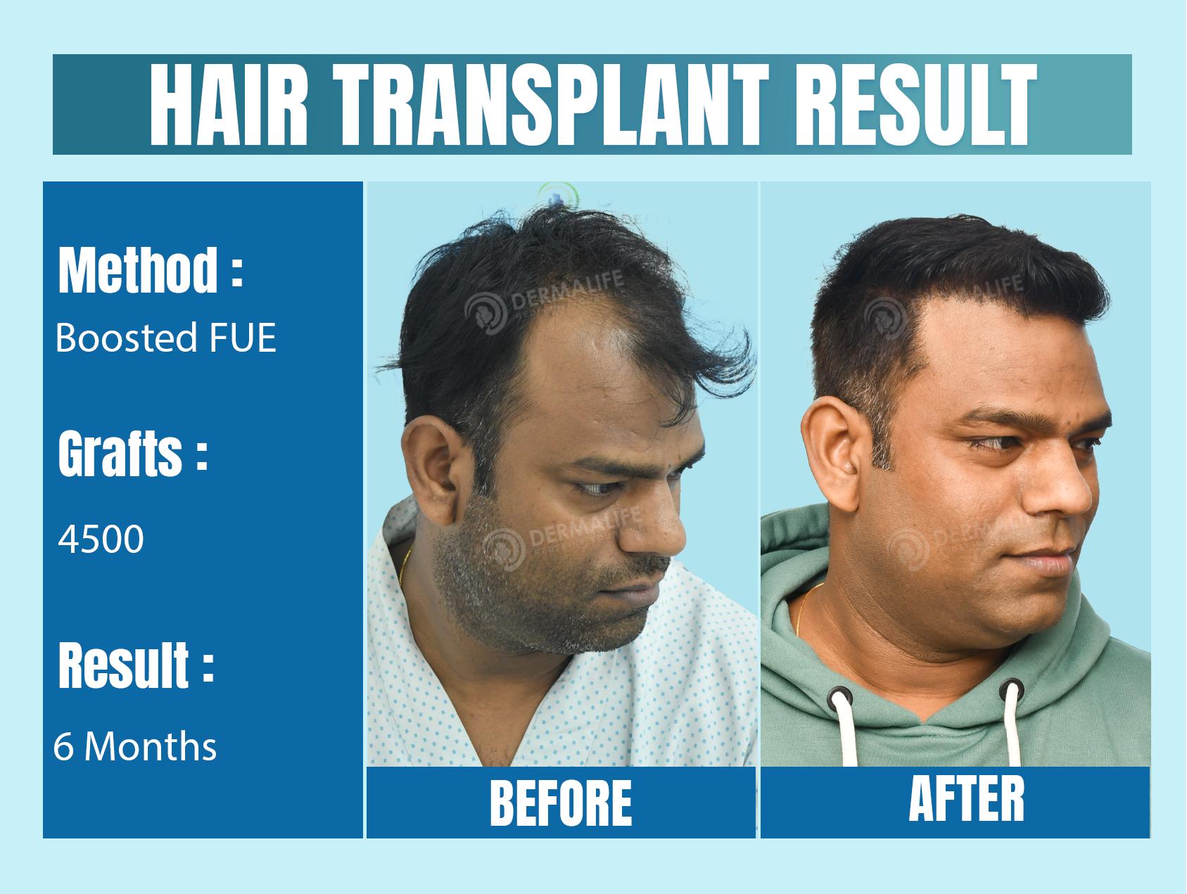 Hair Transplant Before and After Result with 4500 Grafts